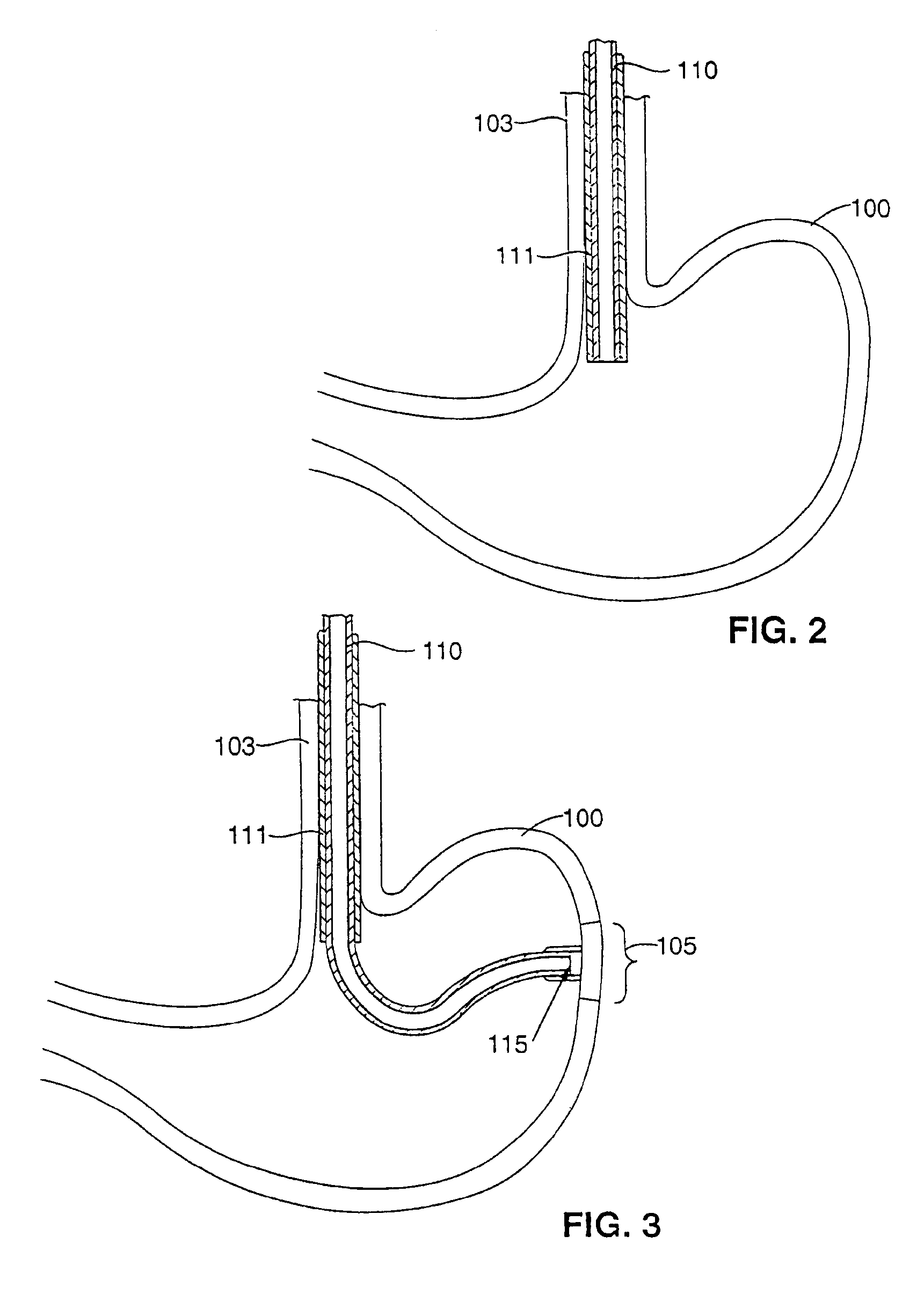 Gastric stimulation anchor and method