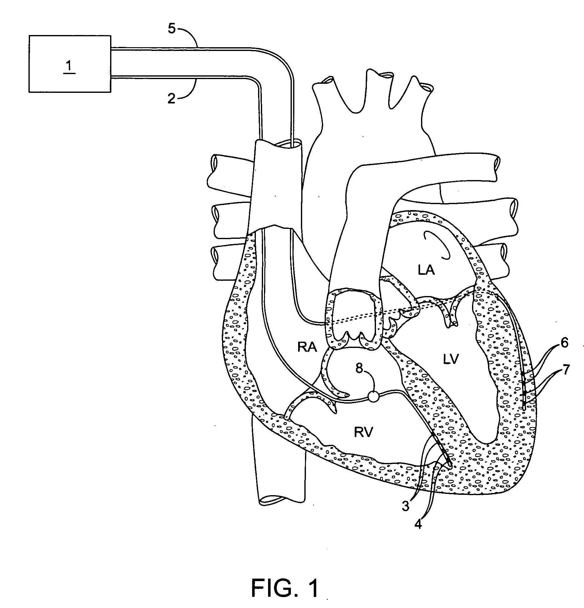 Implantable doppler tomography system