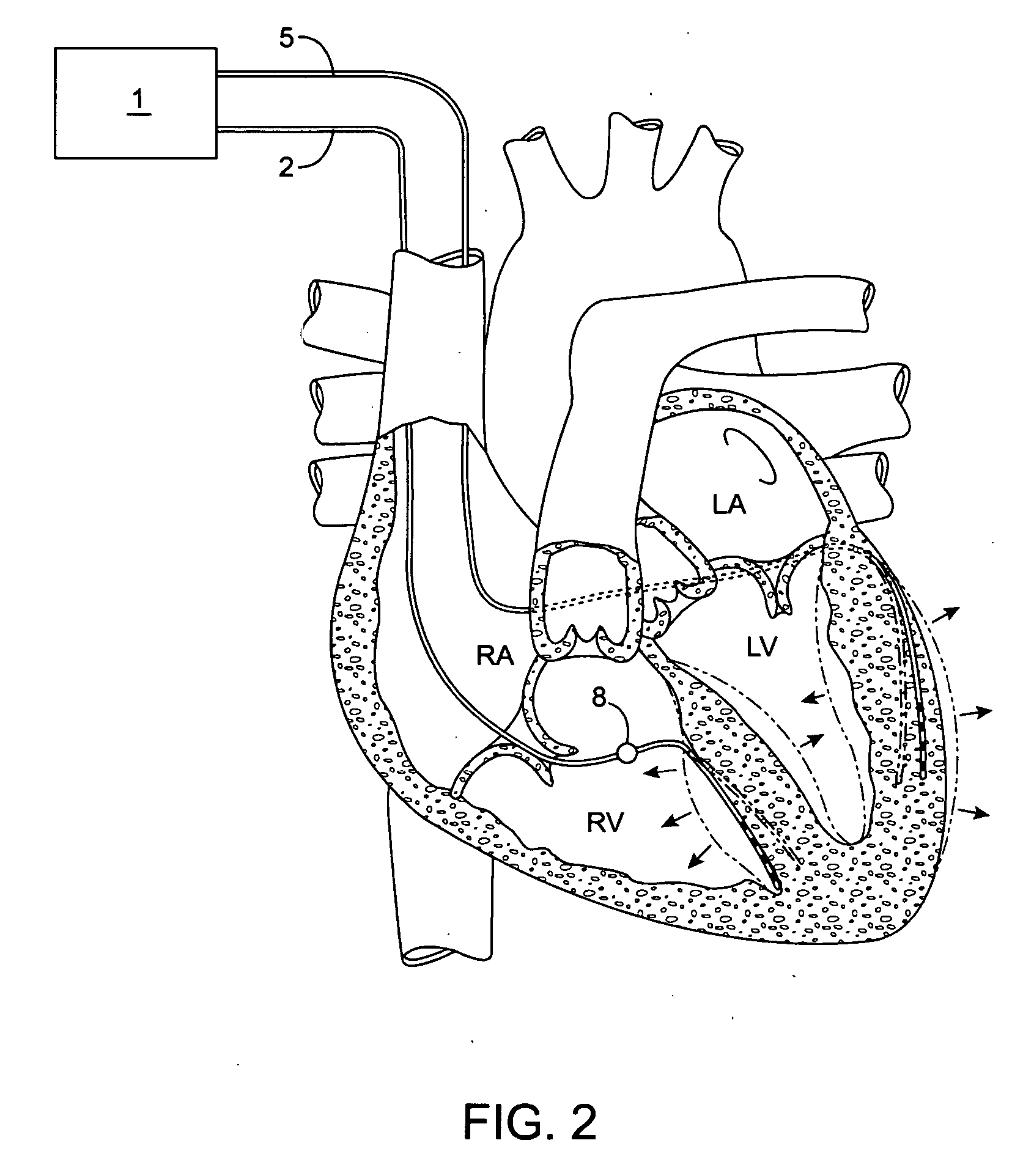 Implantable doppler tomography system