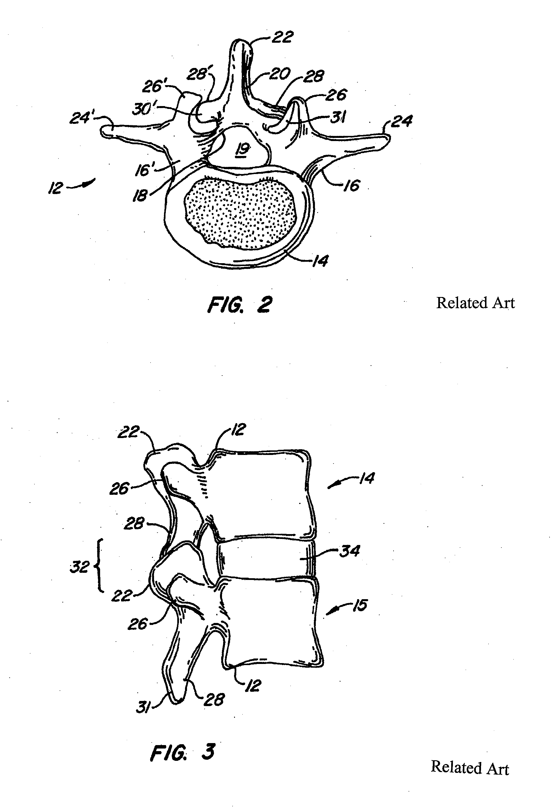 Polymeric joint complex and methods of use