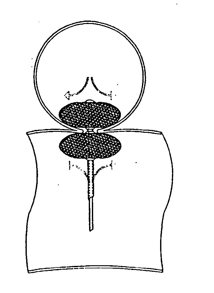 Aneurysm repair method and apparatus