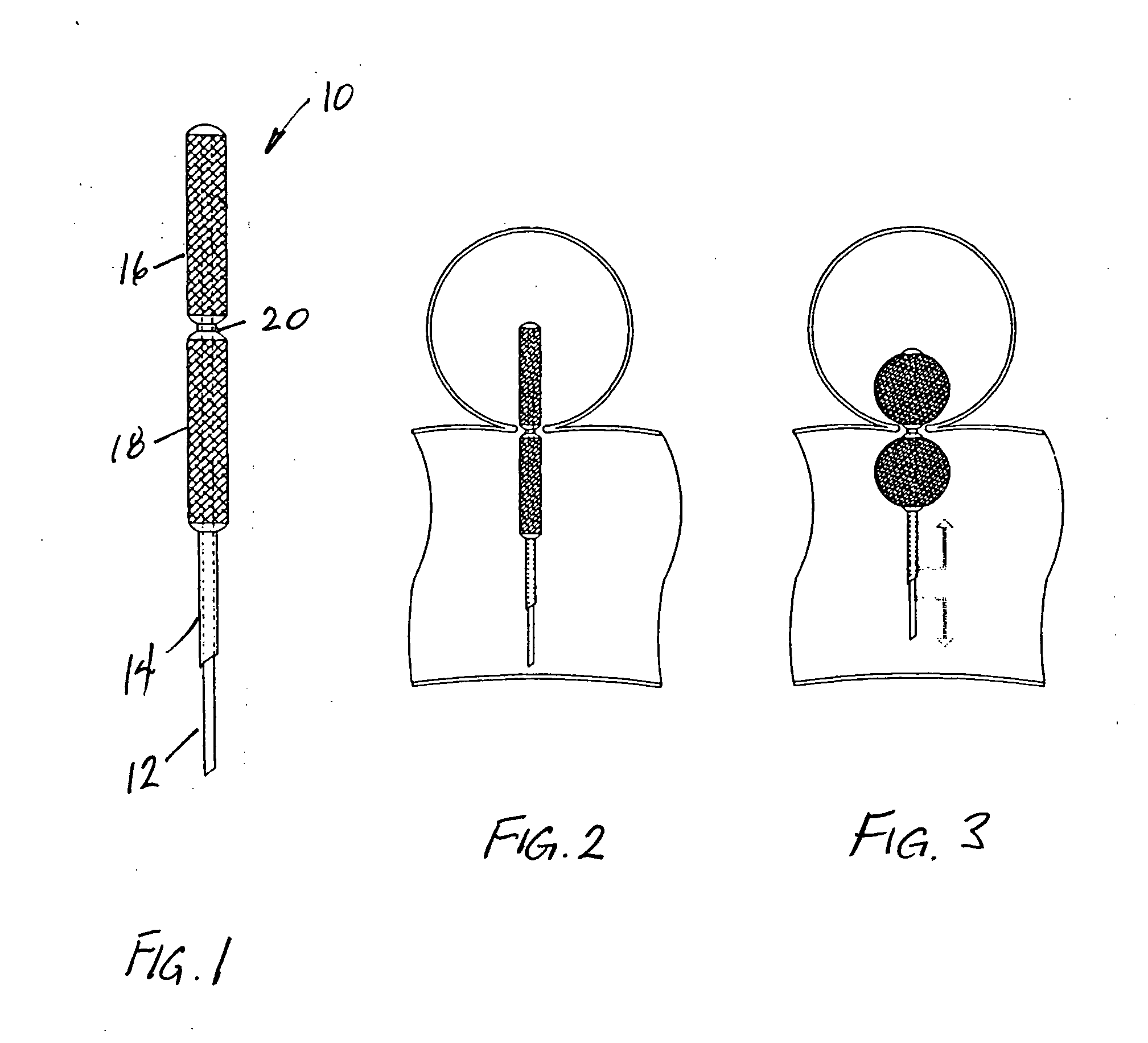 Aneurysm repair method and apparatus