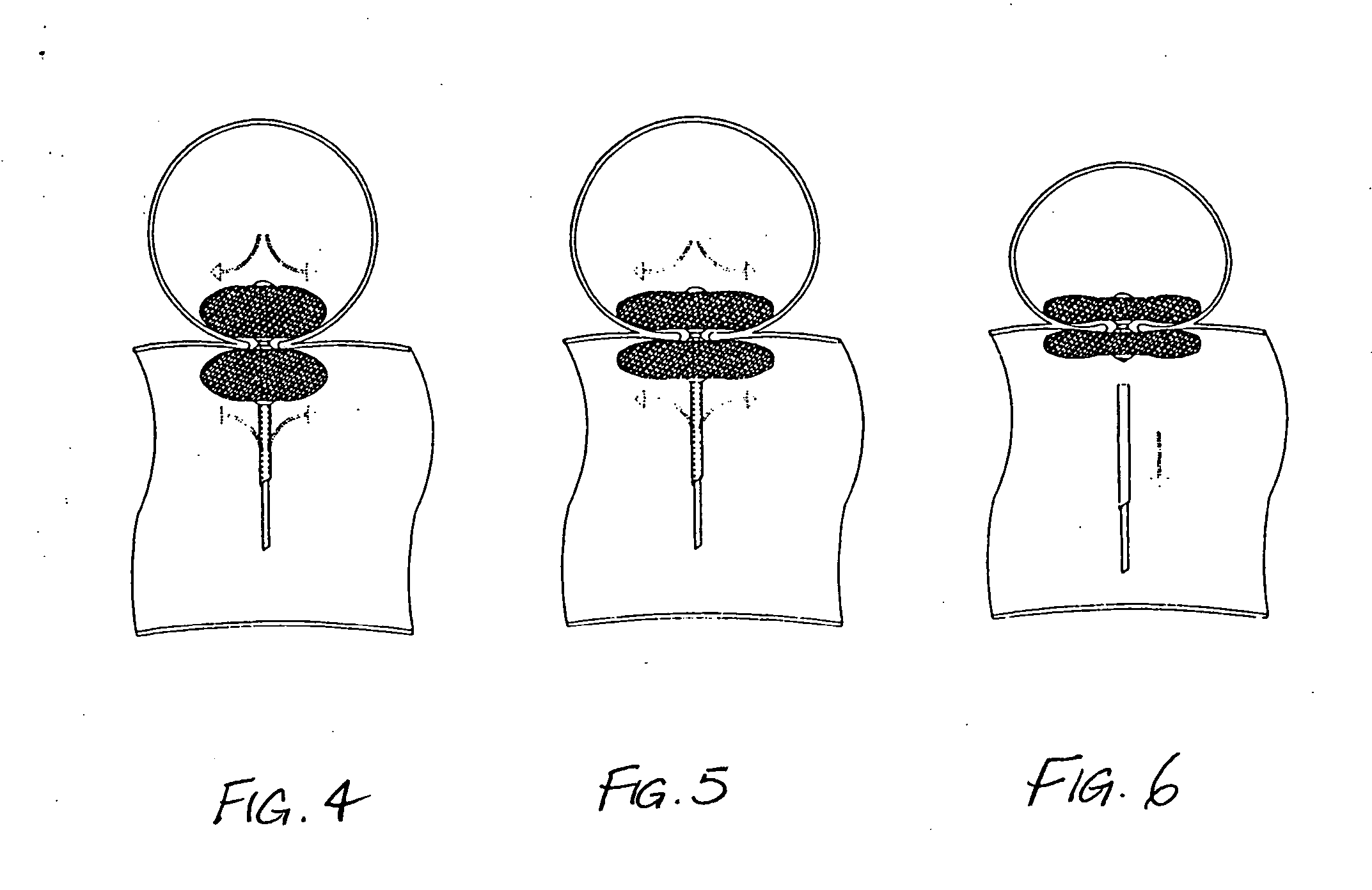 Aneurysm repair method and apparatus