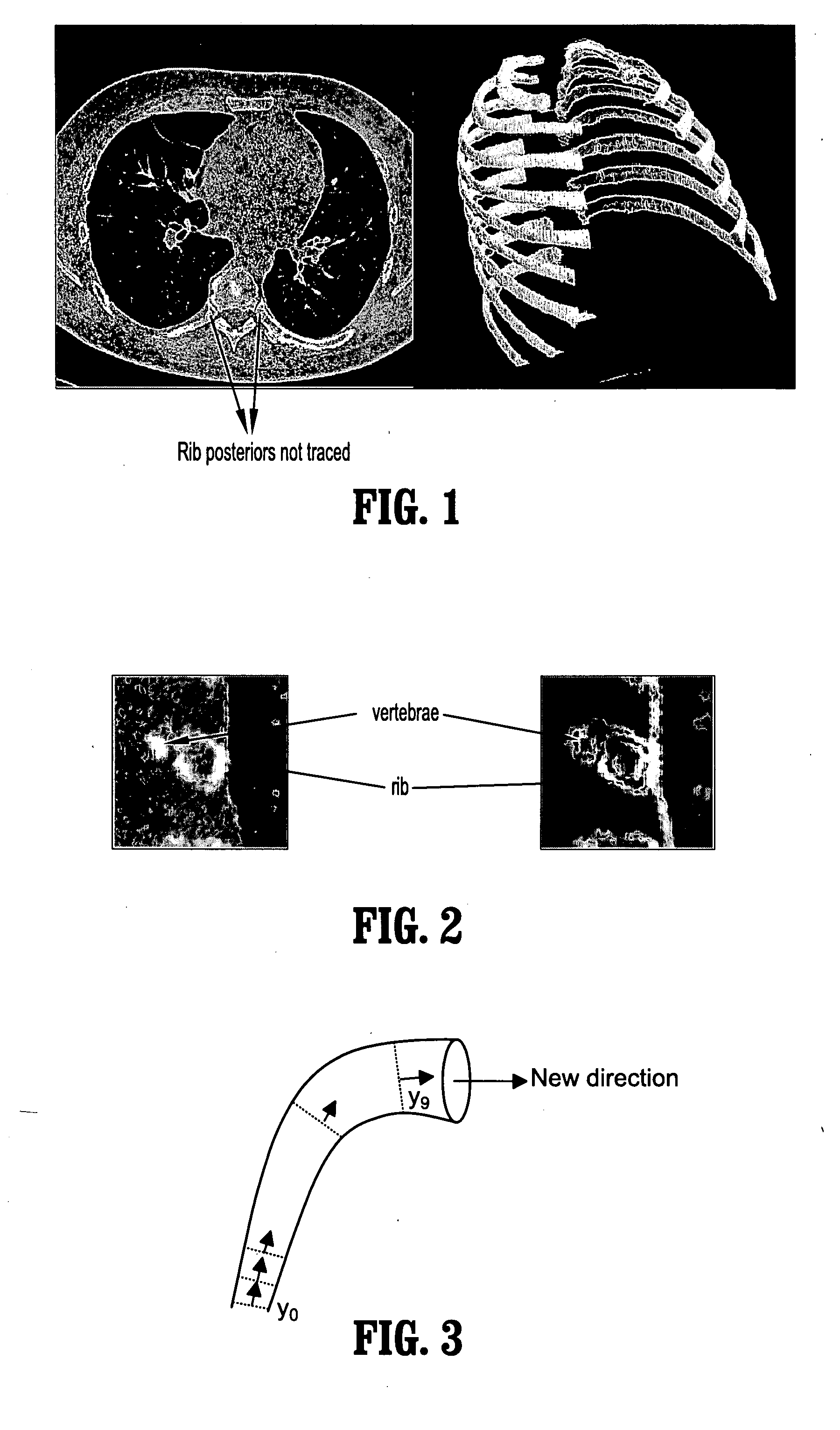 System and Method For Tracing Rib Posterior In Chest CT Volumes