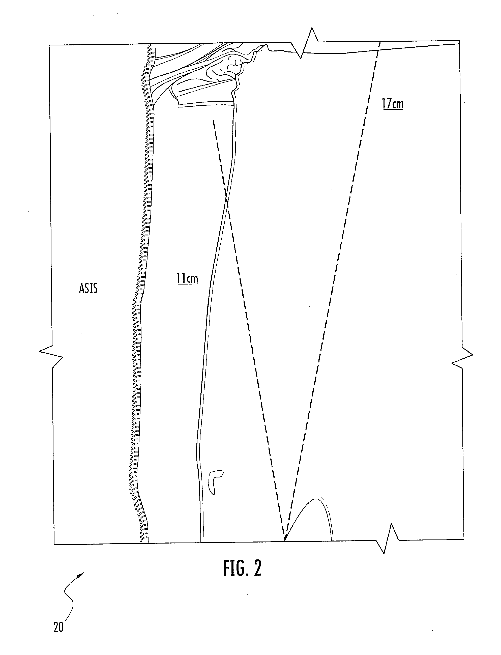 Surgery port placement system and related methods