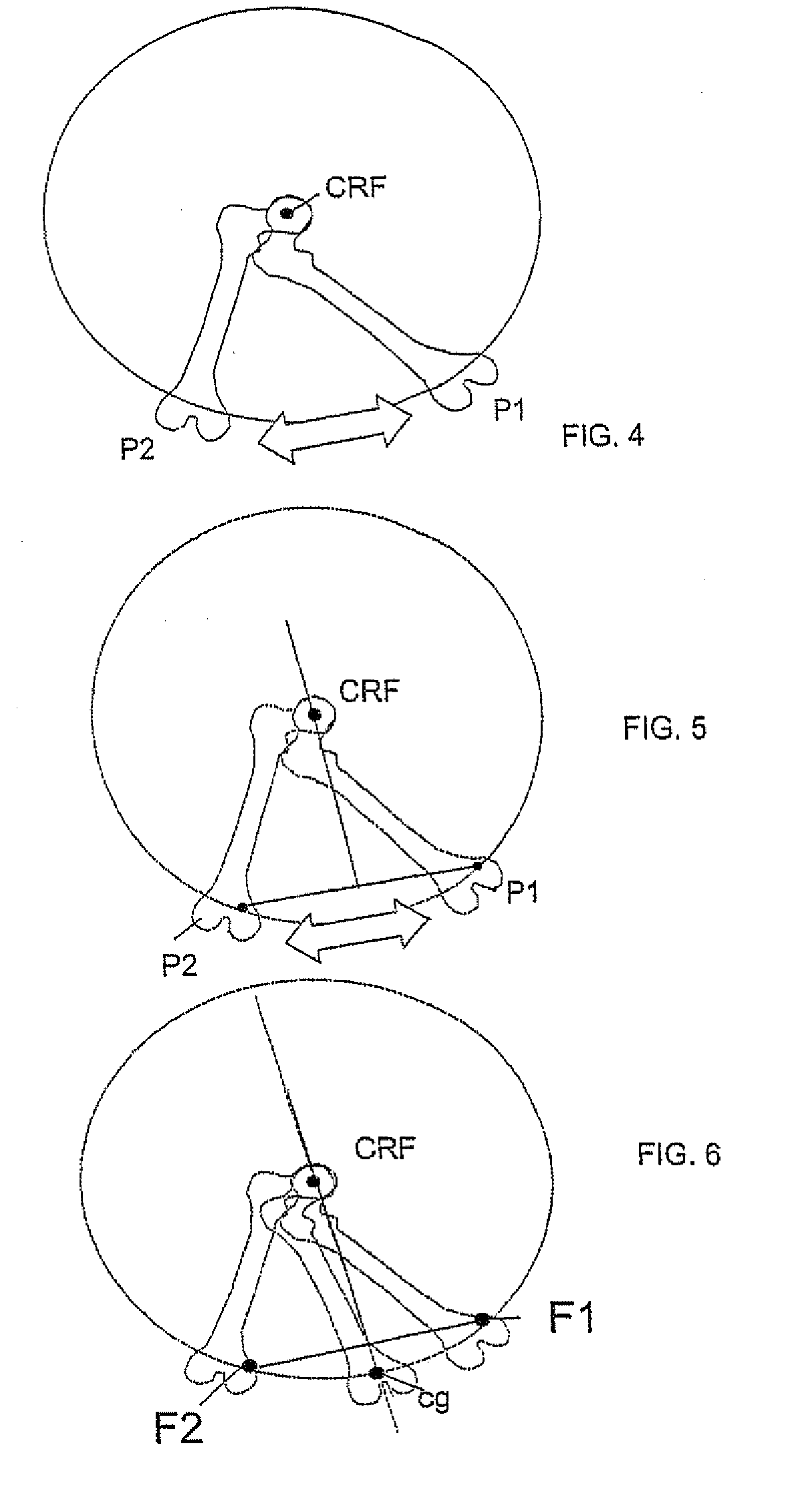 Sighting instrument for determining the mechanical axis of the femur