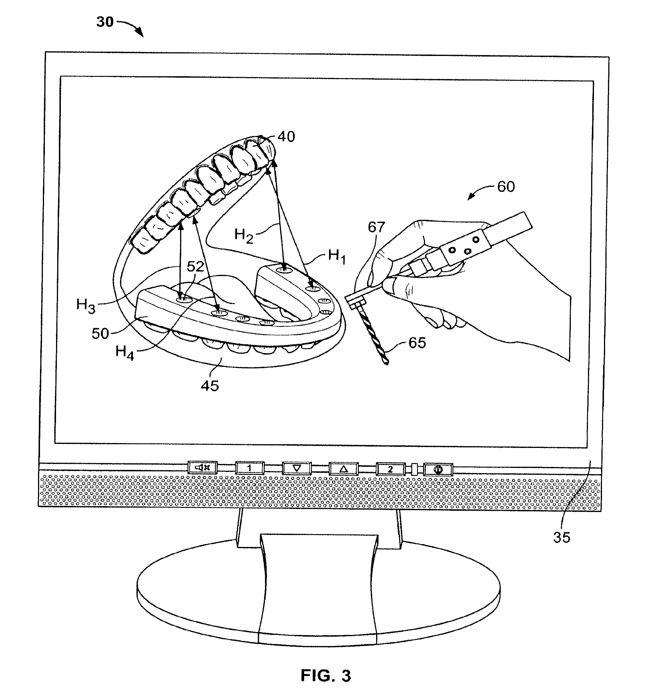 Method For Pre-Operative Visualization Of Instrumentation Used With A Surgical Guide For Dental Implant Placement