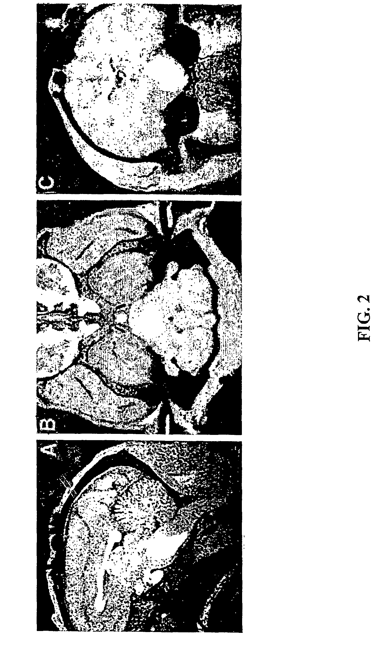 Method for convection enhanced delivery of therapeutic agents