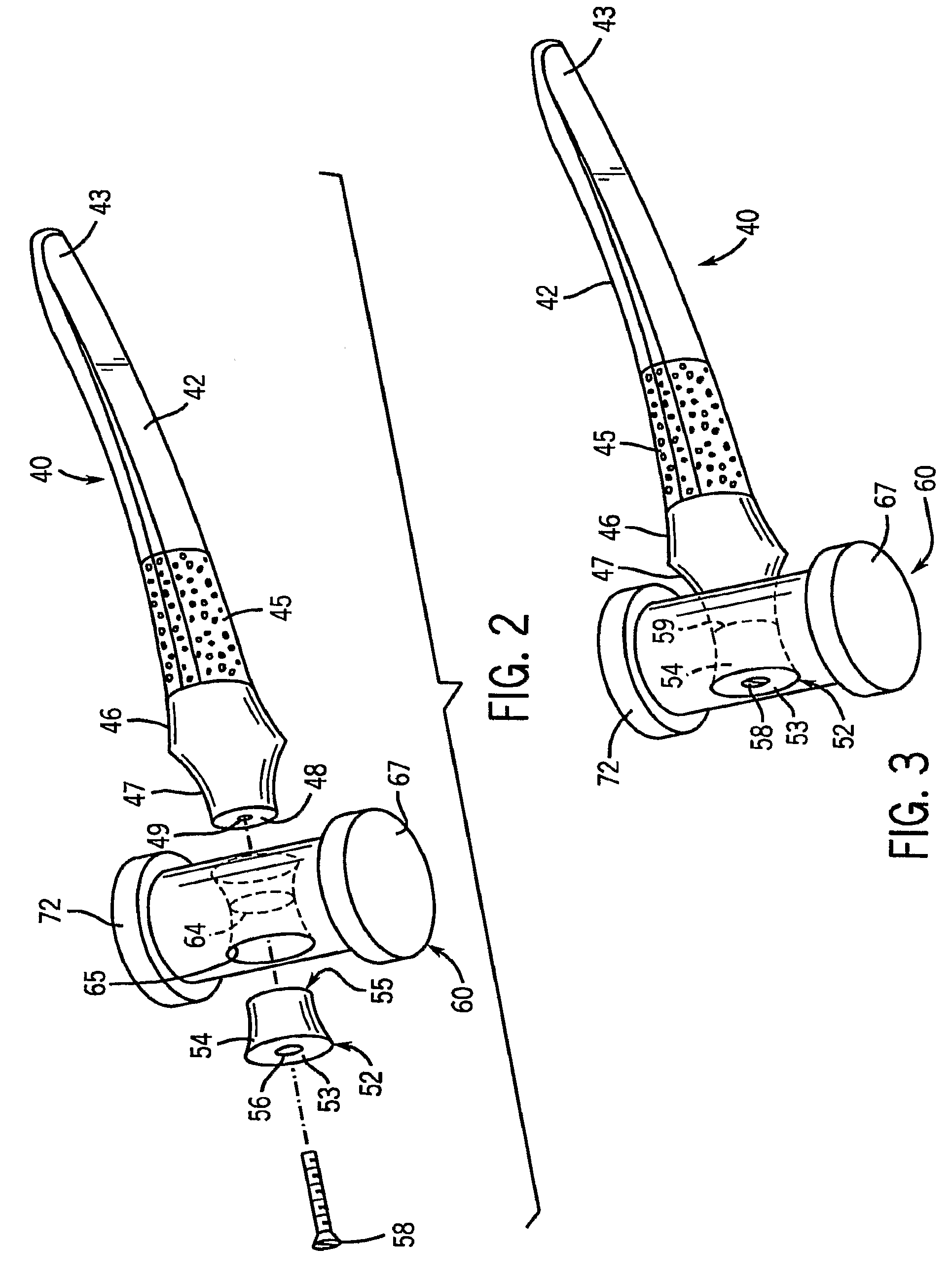 Prosthetic elbow replacement