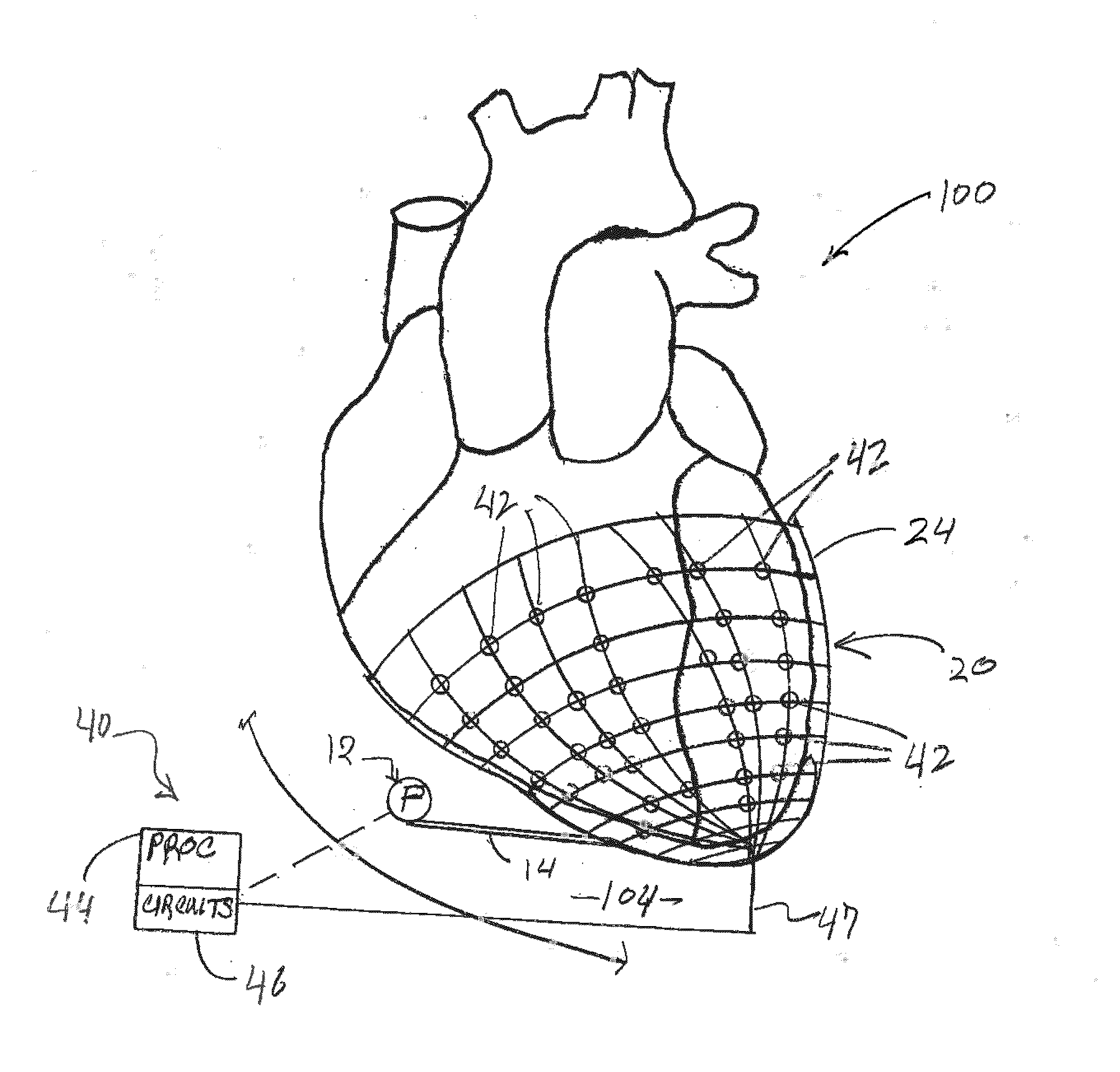 System for treating heart valve malfunction including mitral regurgitation