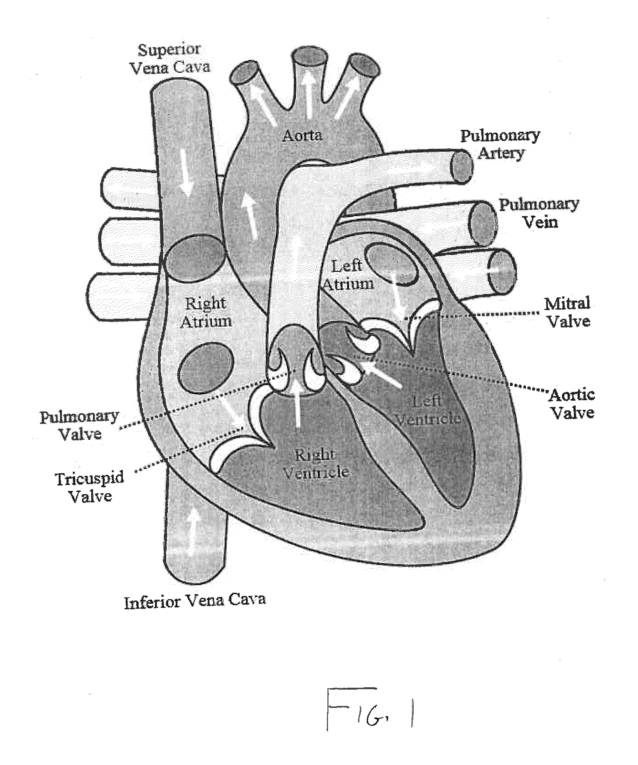 System for treating heart valve malfunction including mitral regurgitation