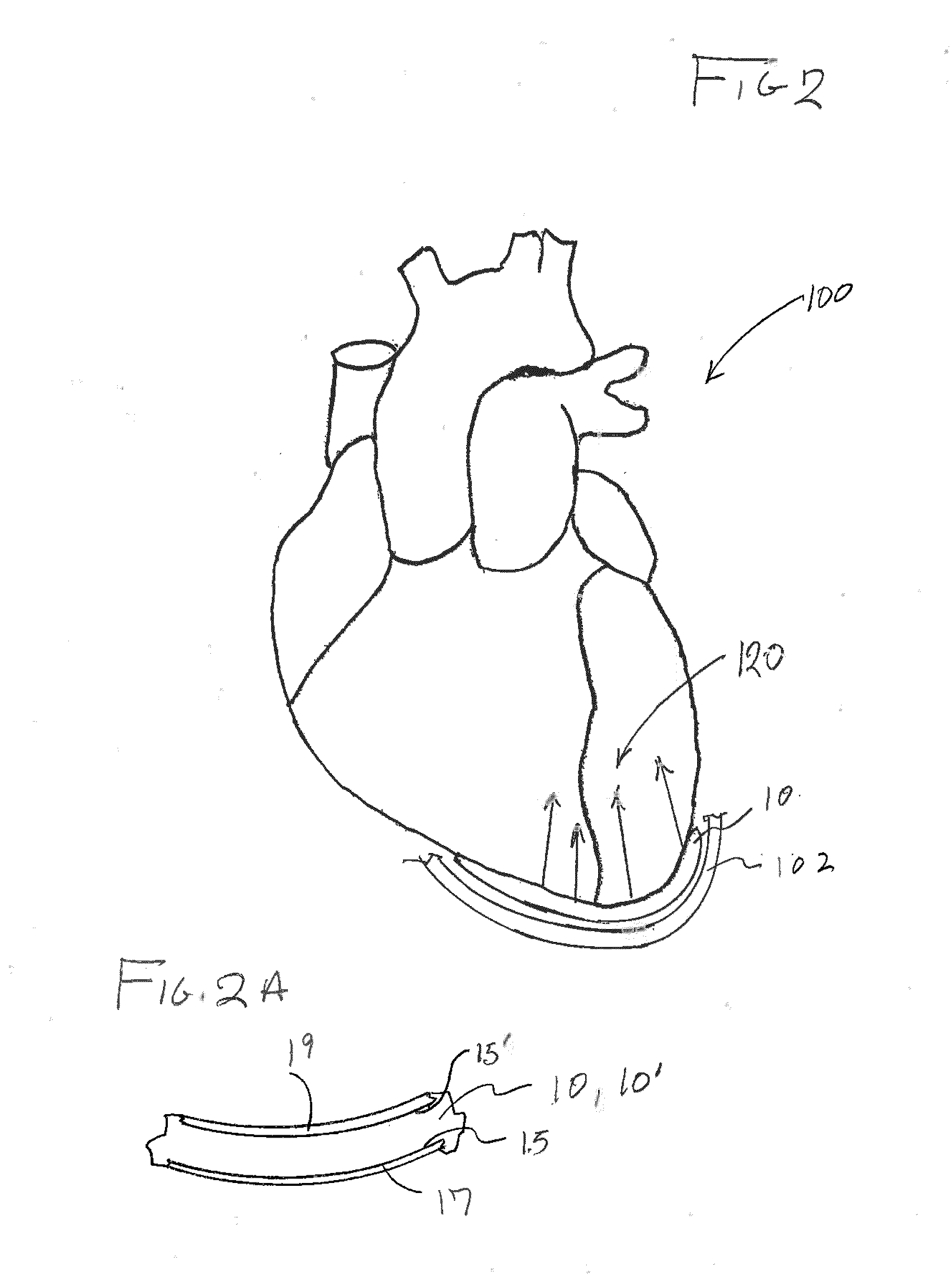 System for treating heart valve malfunction including mitral regurgitation