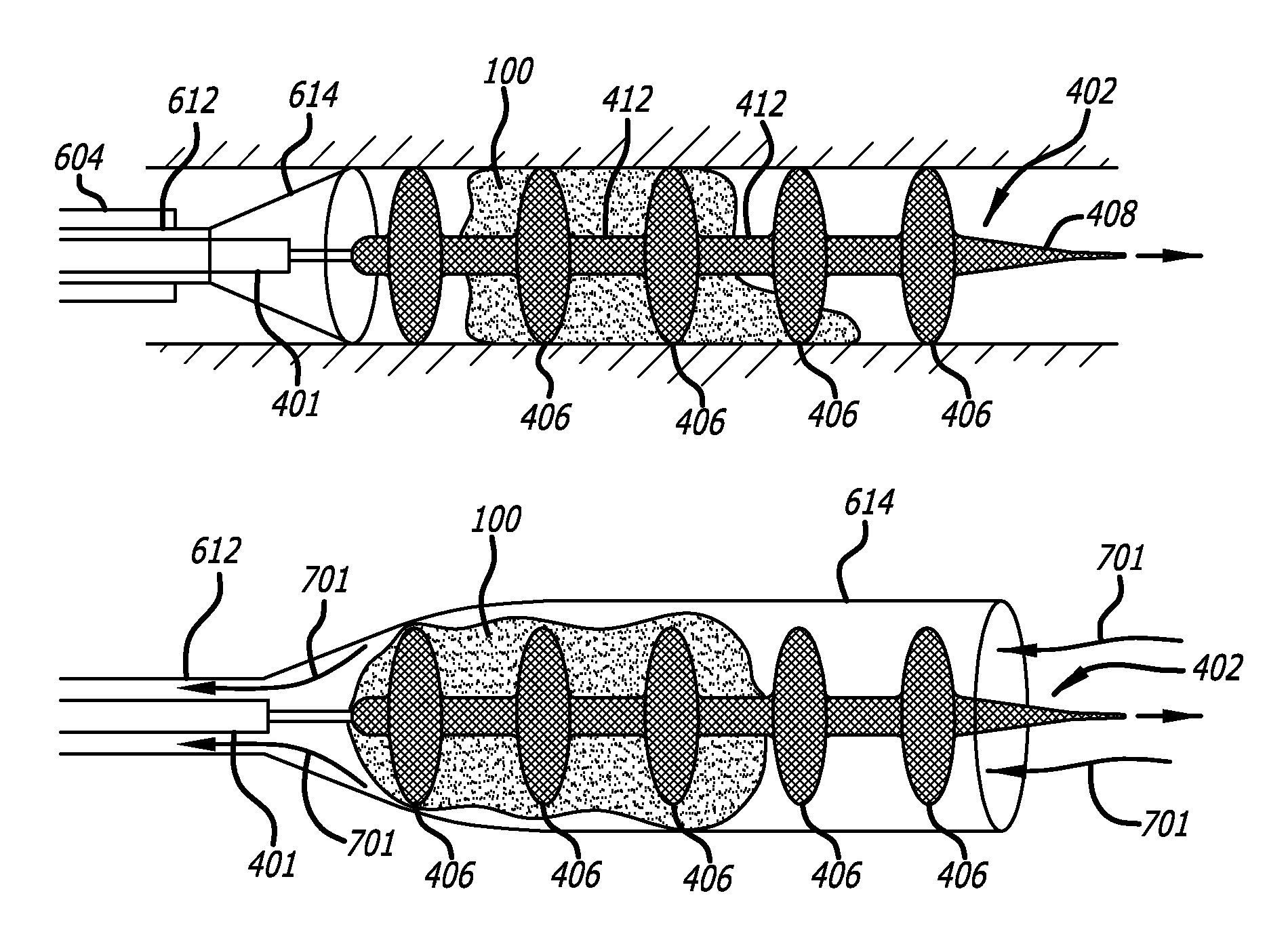 Methods and apparatus for treating embolism