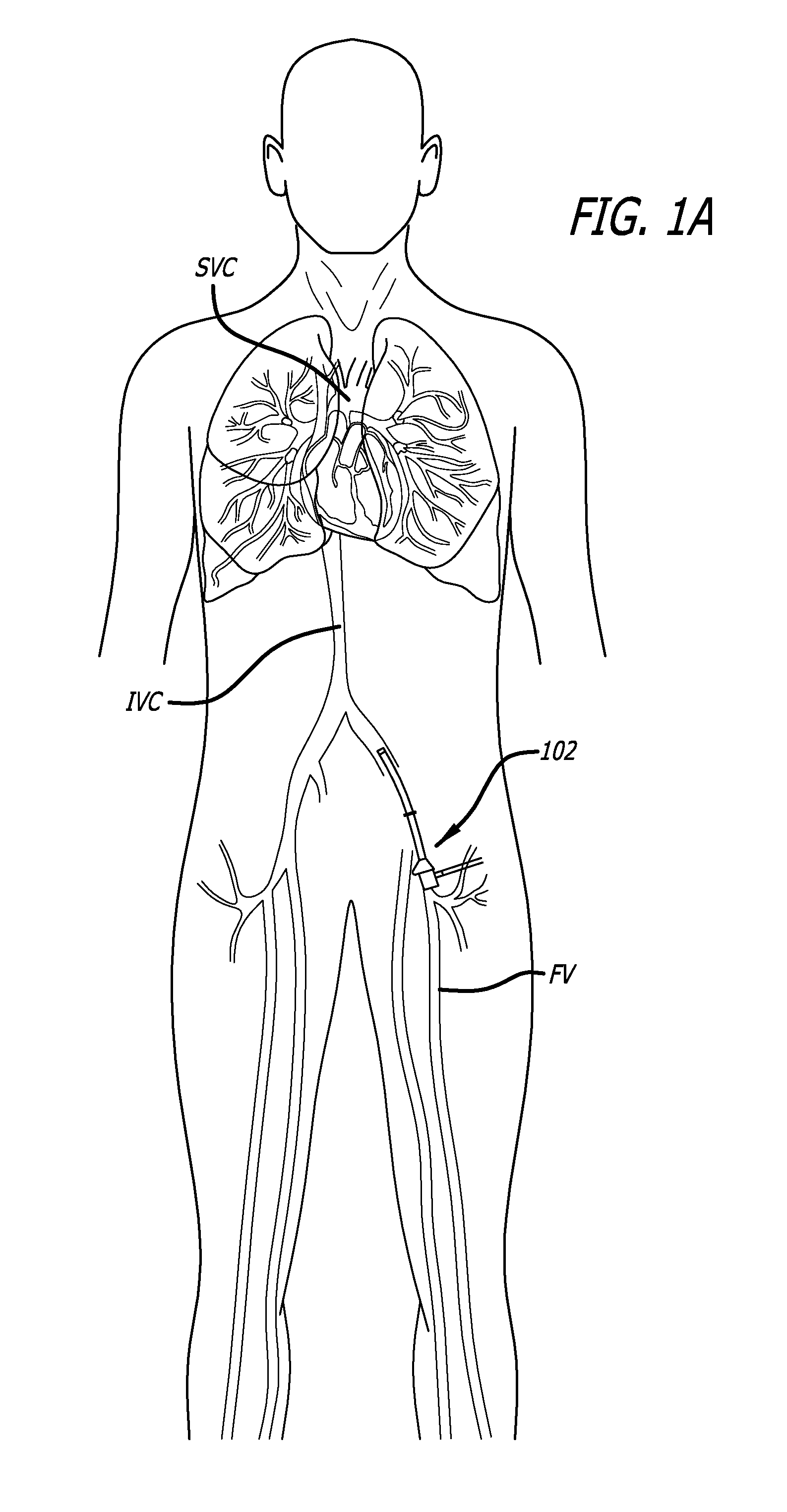 Methods and apparatus for treating embolism