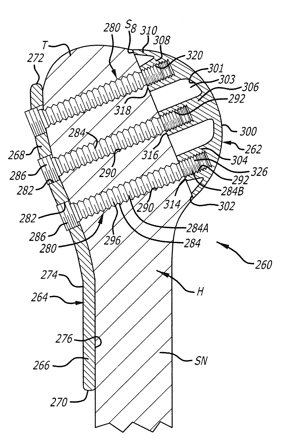 System and method for fracture replacement of comminuted bone fractures or portions thereof adjacent bone joints