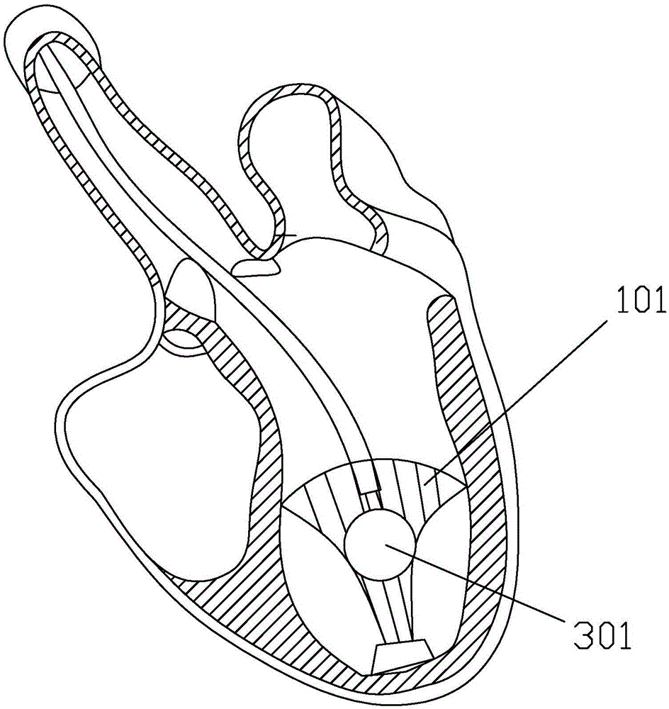 Heart volume reduction implant