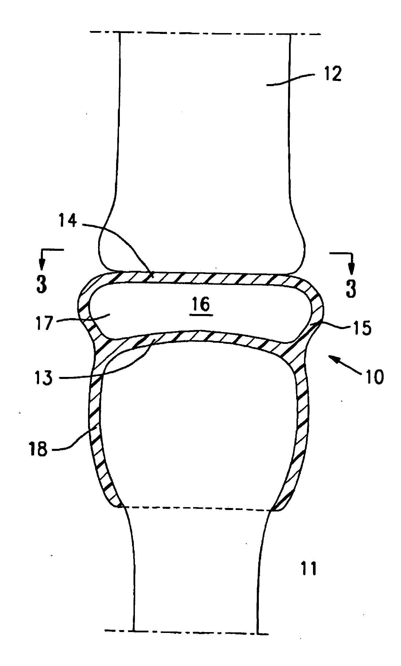 Resilient medically inflatable interpositional arthroplasty device