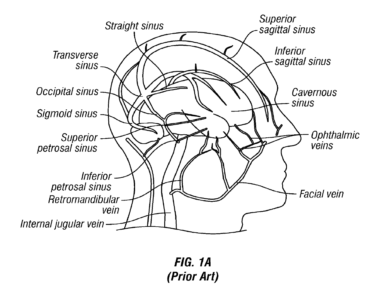 Methods, systems and devices for treatment of cerebrospinal venous insufficiency and multiple sclerosis