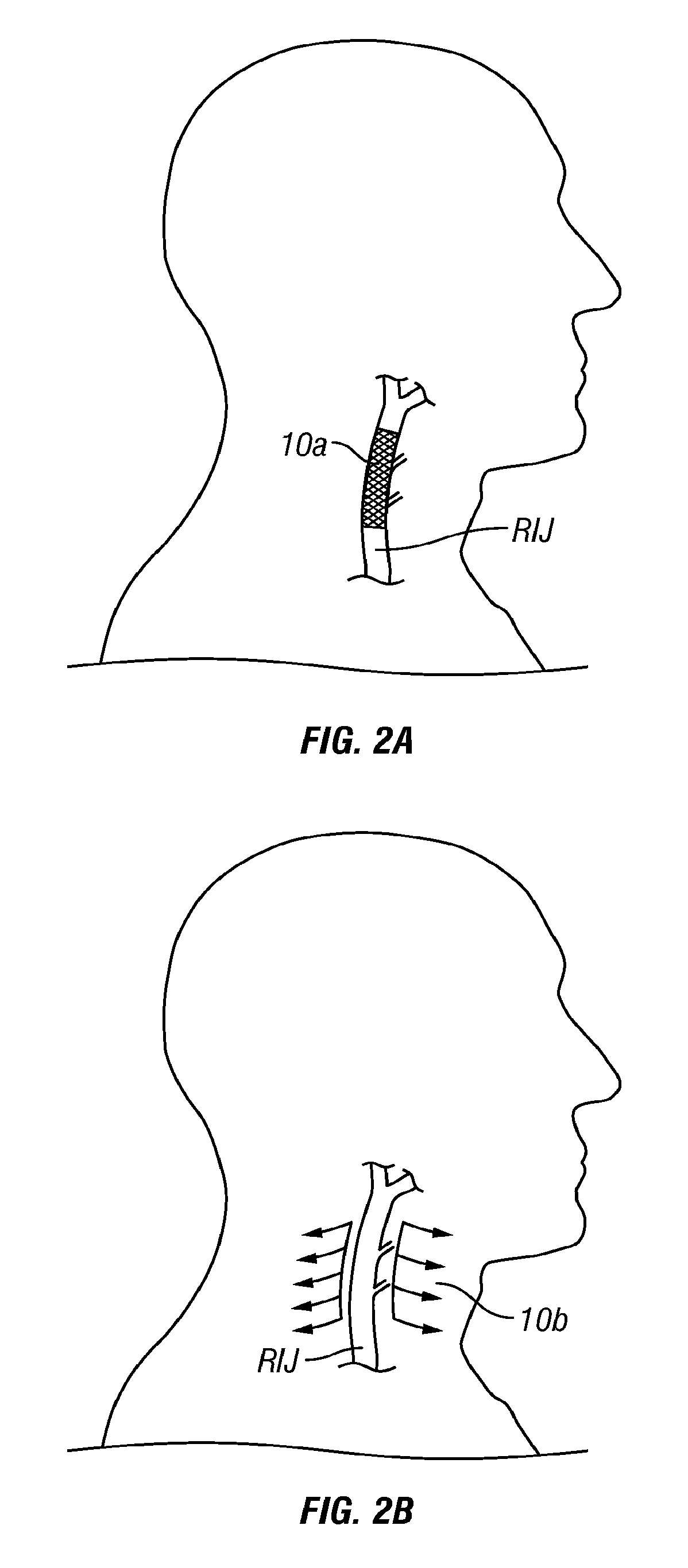 Methods, systems and devices for treatment of cerebrospinal venous insufficiency and multiple sclerosis