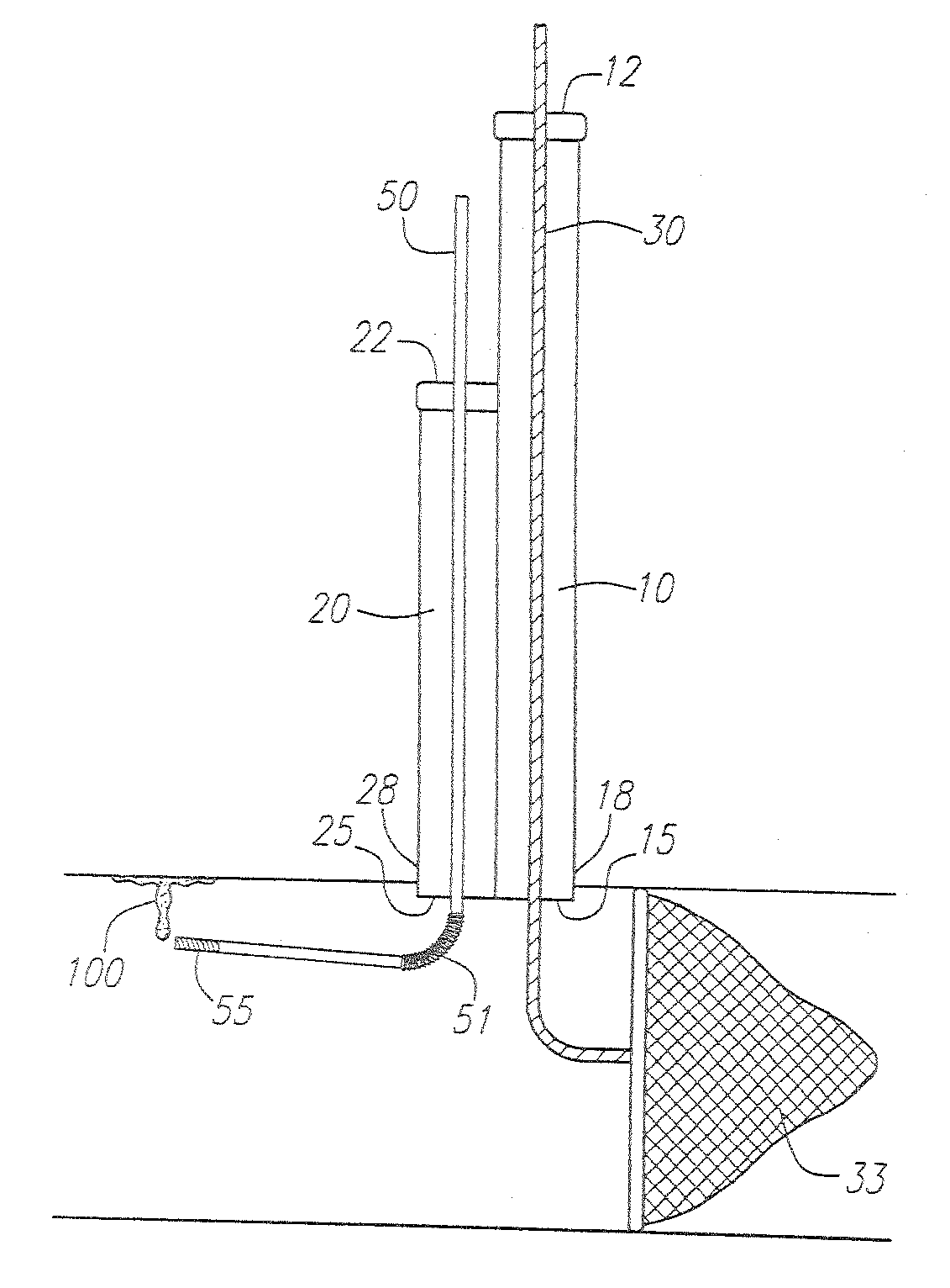 Direct Access Atherectomy Devices and Methods of Use