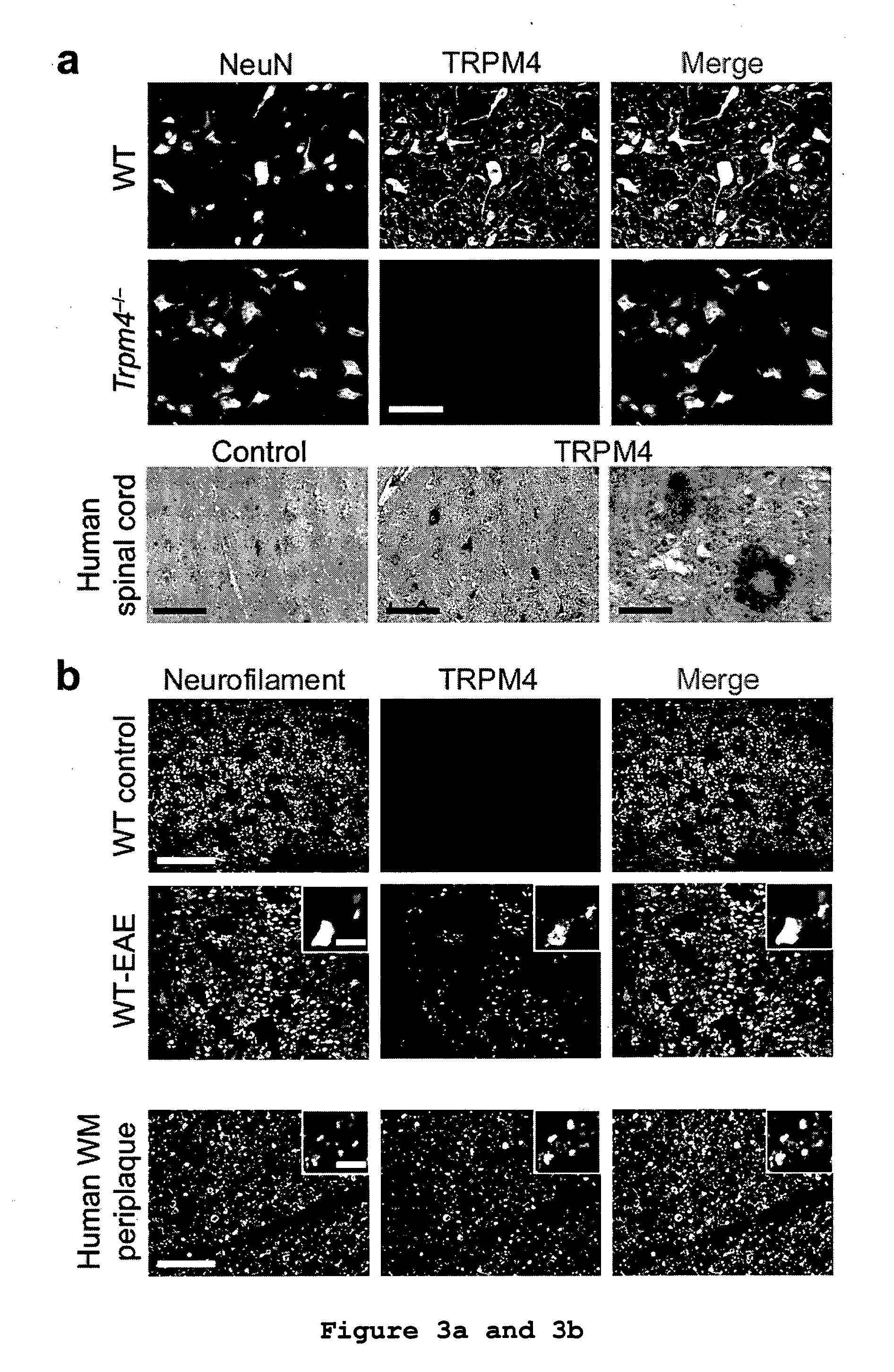 Inhibitor of trpm-4 ion channel for treating or preventing neurodegeneration