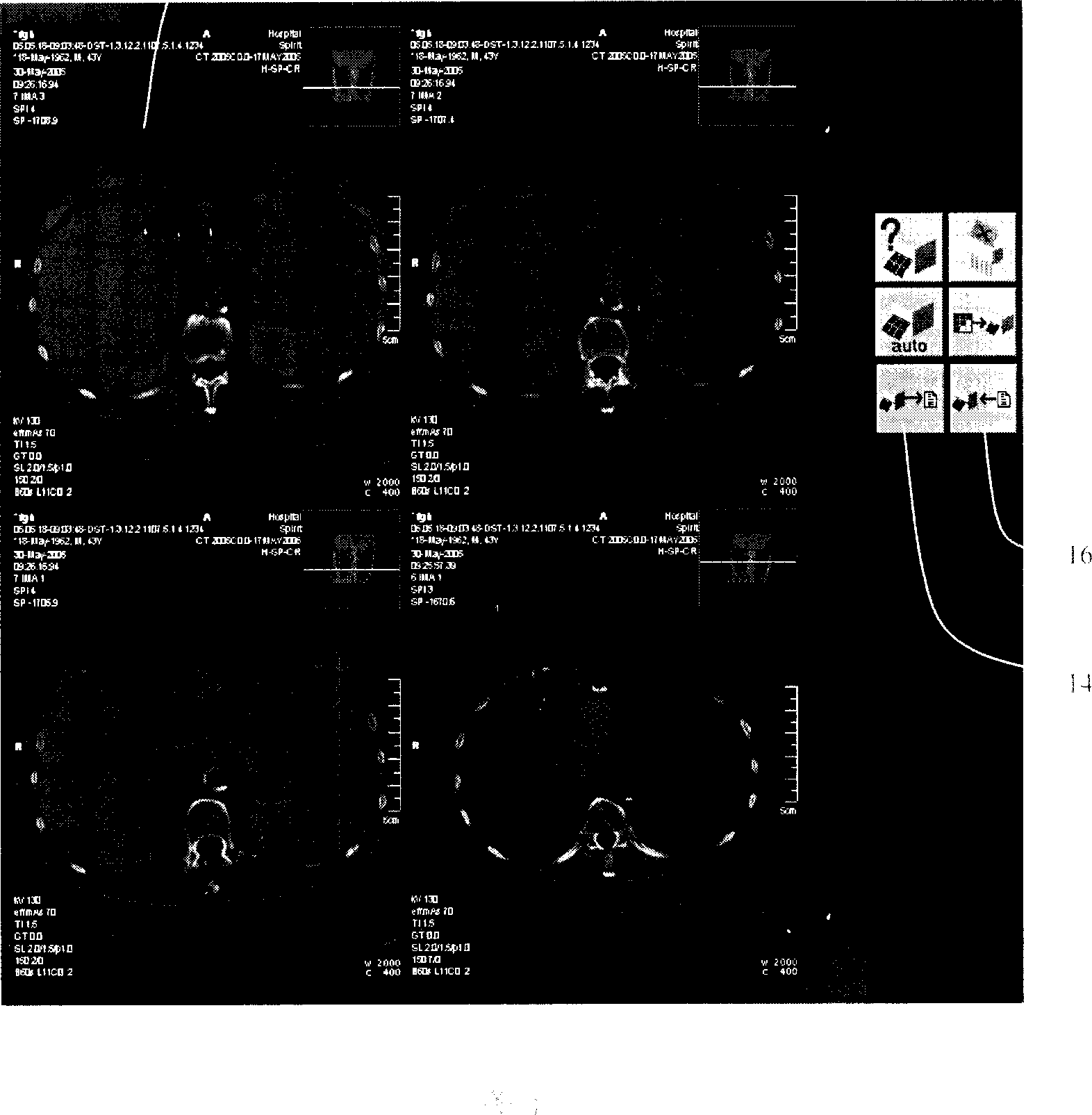 CT image digitalized storing and transfer method