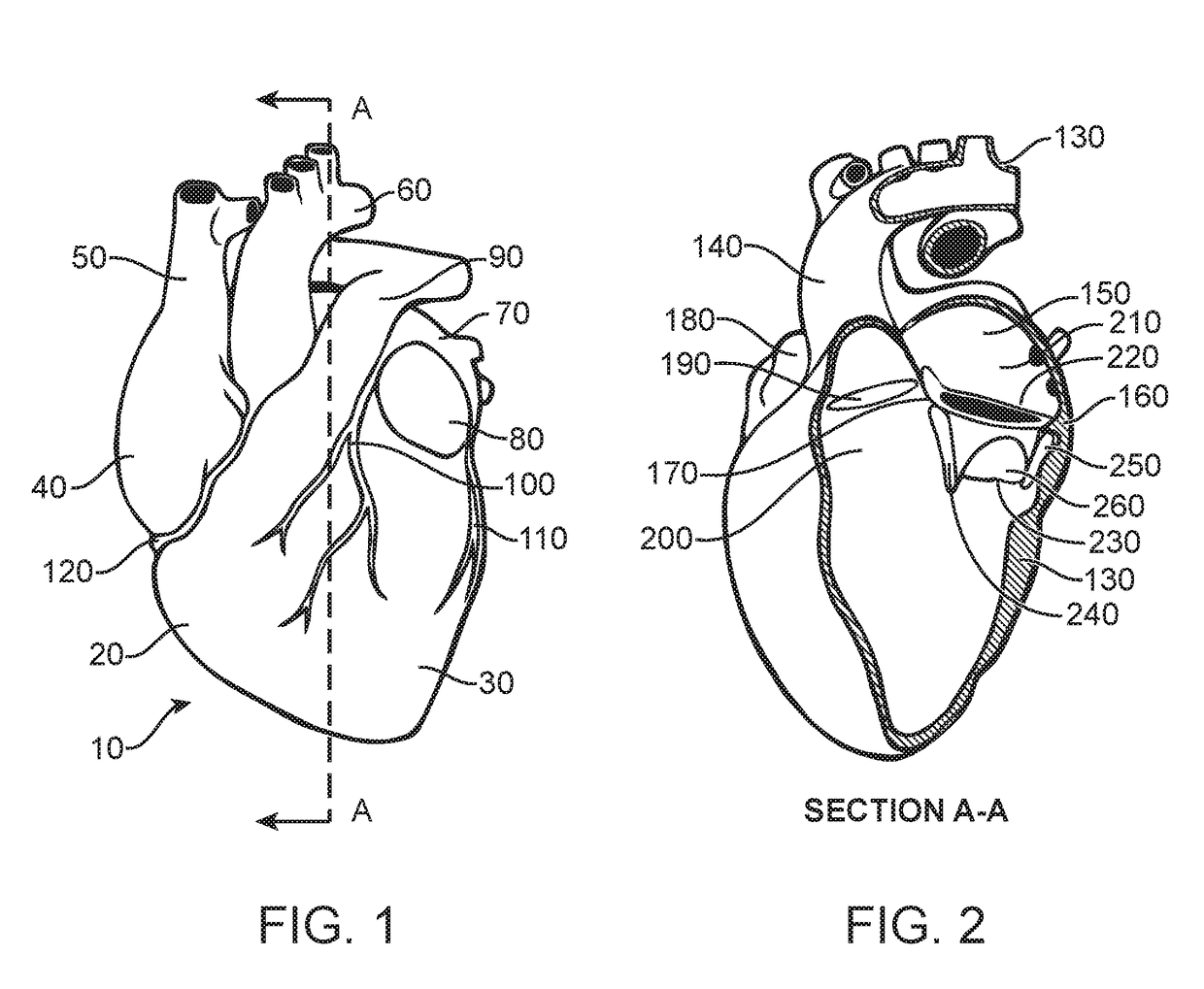 Prosthetic valve for avoiding obstruction of outflow