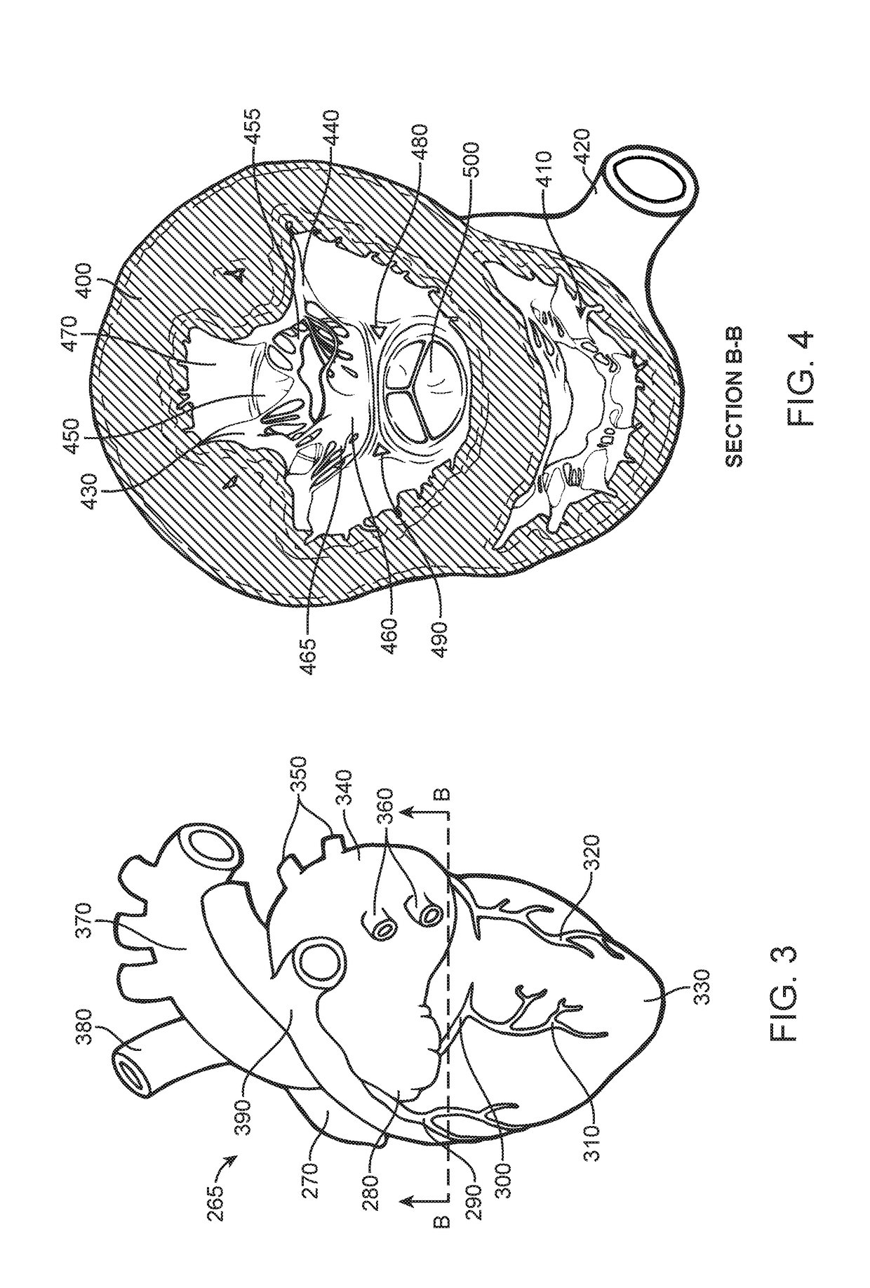 Prosthetic valve for avoiding obstruction of outflow