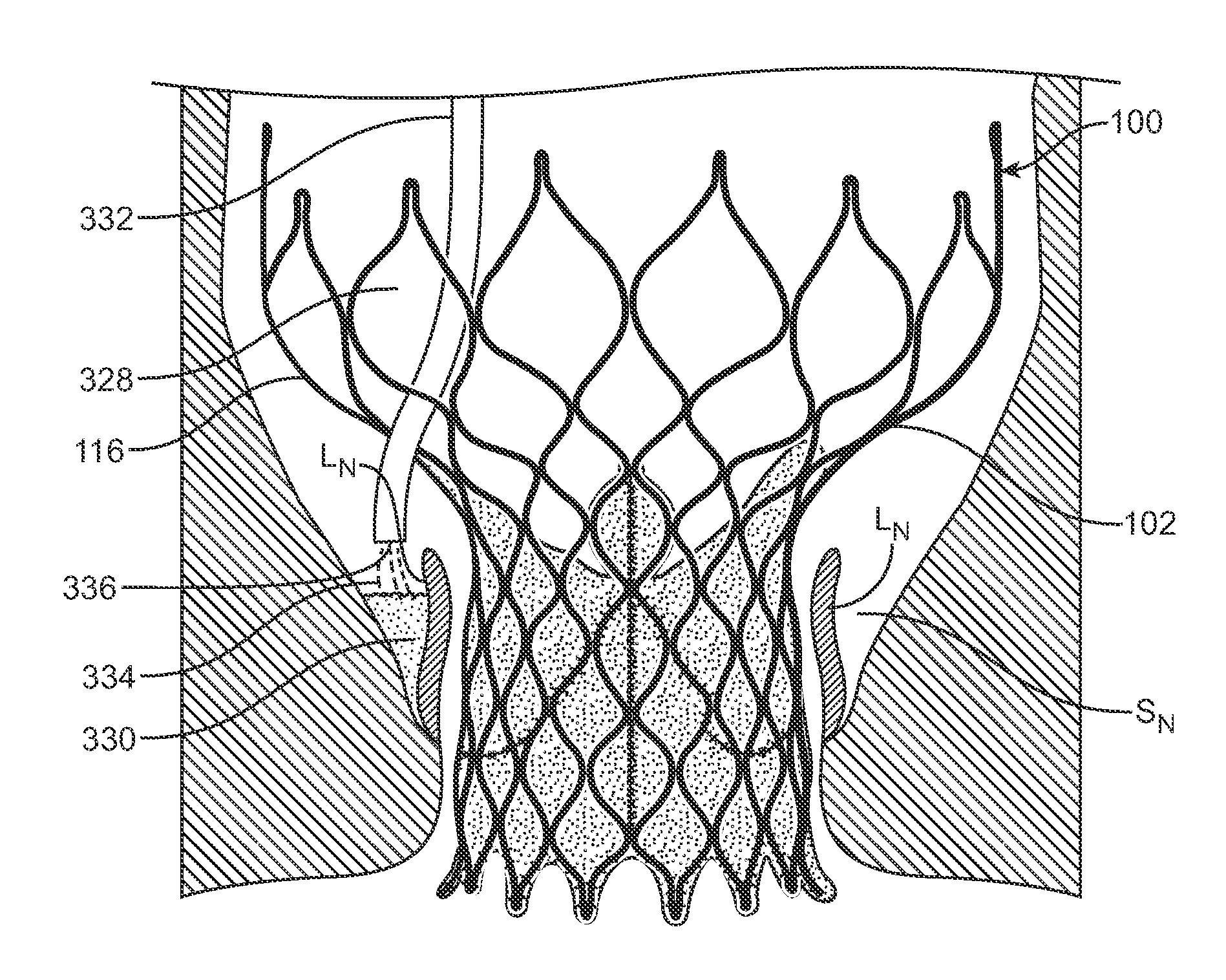 Methods and Devices for Repairing and/or Preventing Paravalvular Leakage Post-Implantation of a Valve Prosthesis