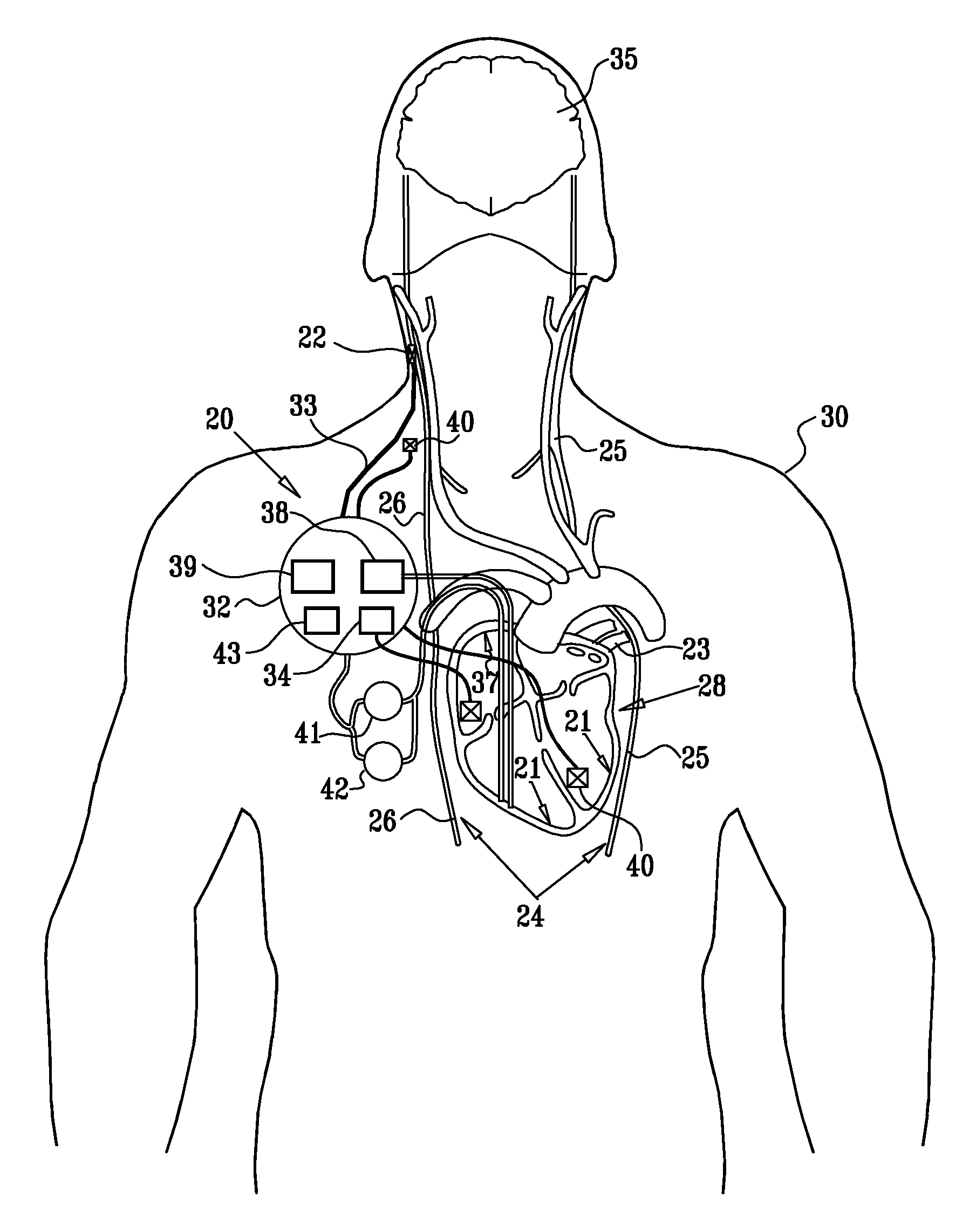 Parasympathetic nerve stimulation