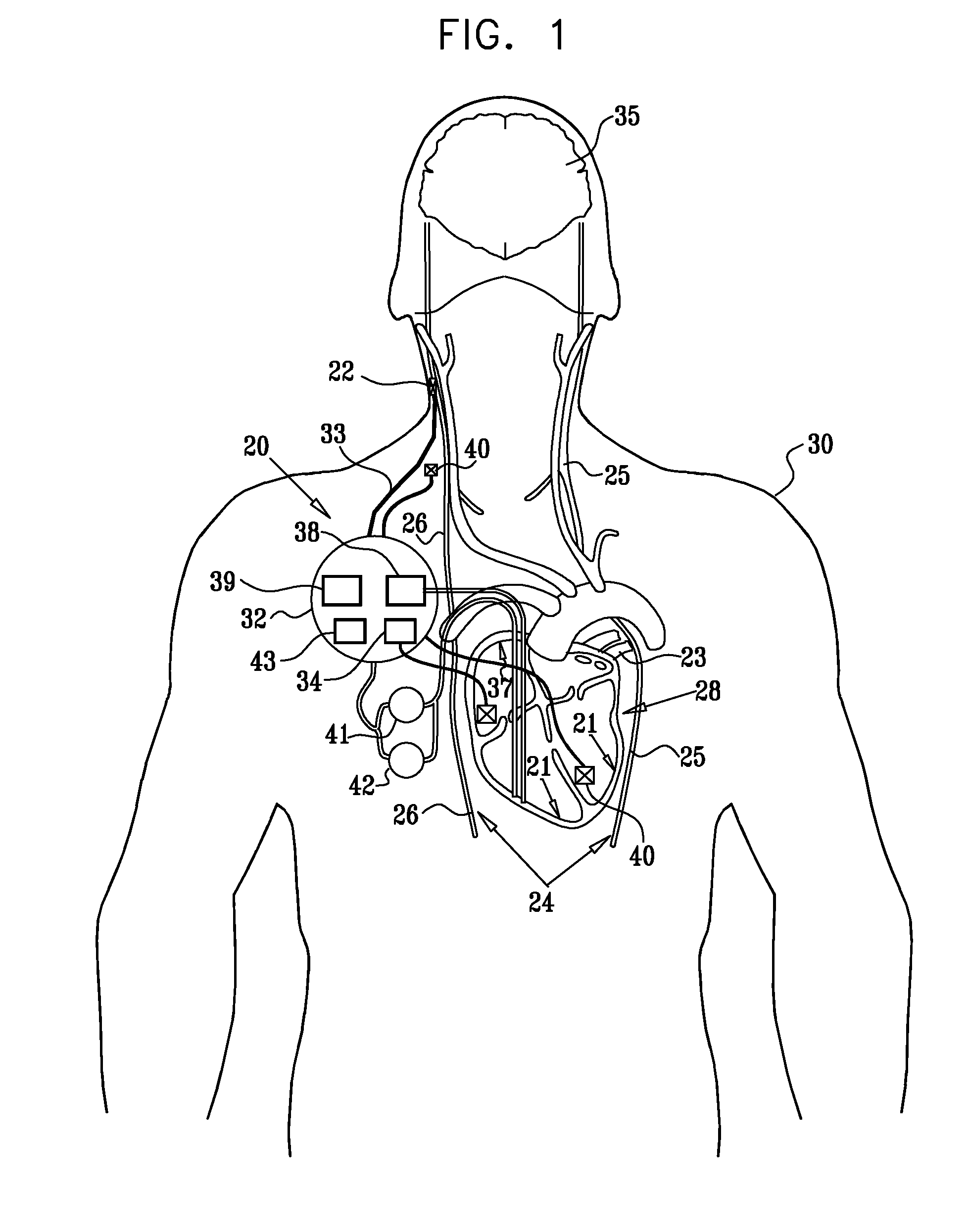 Parasympathetic nerve stimulation