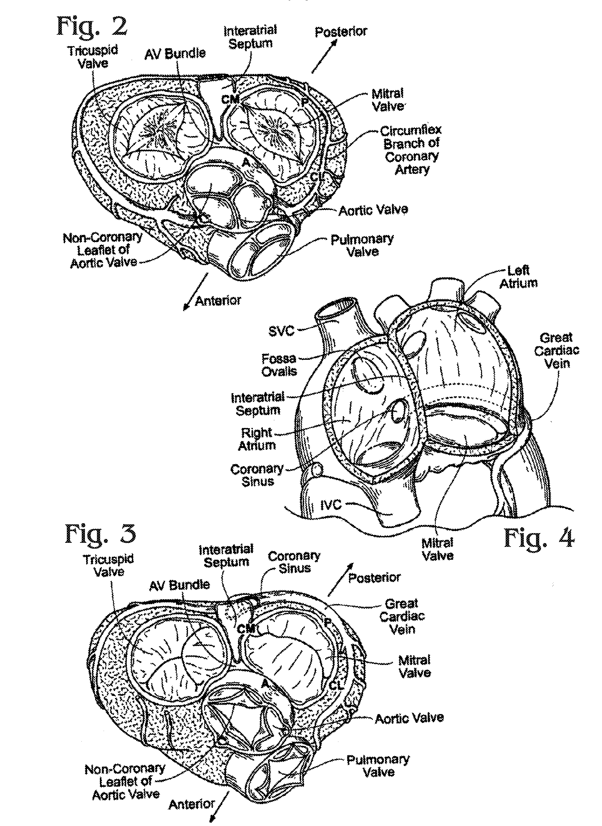 Methods of delivery of flexible heart valves