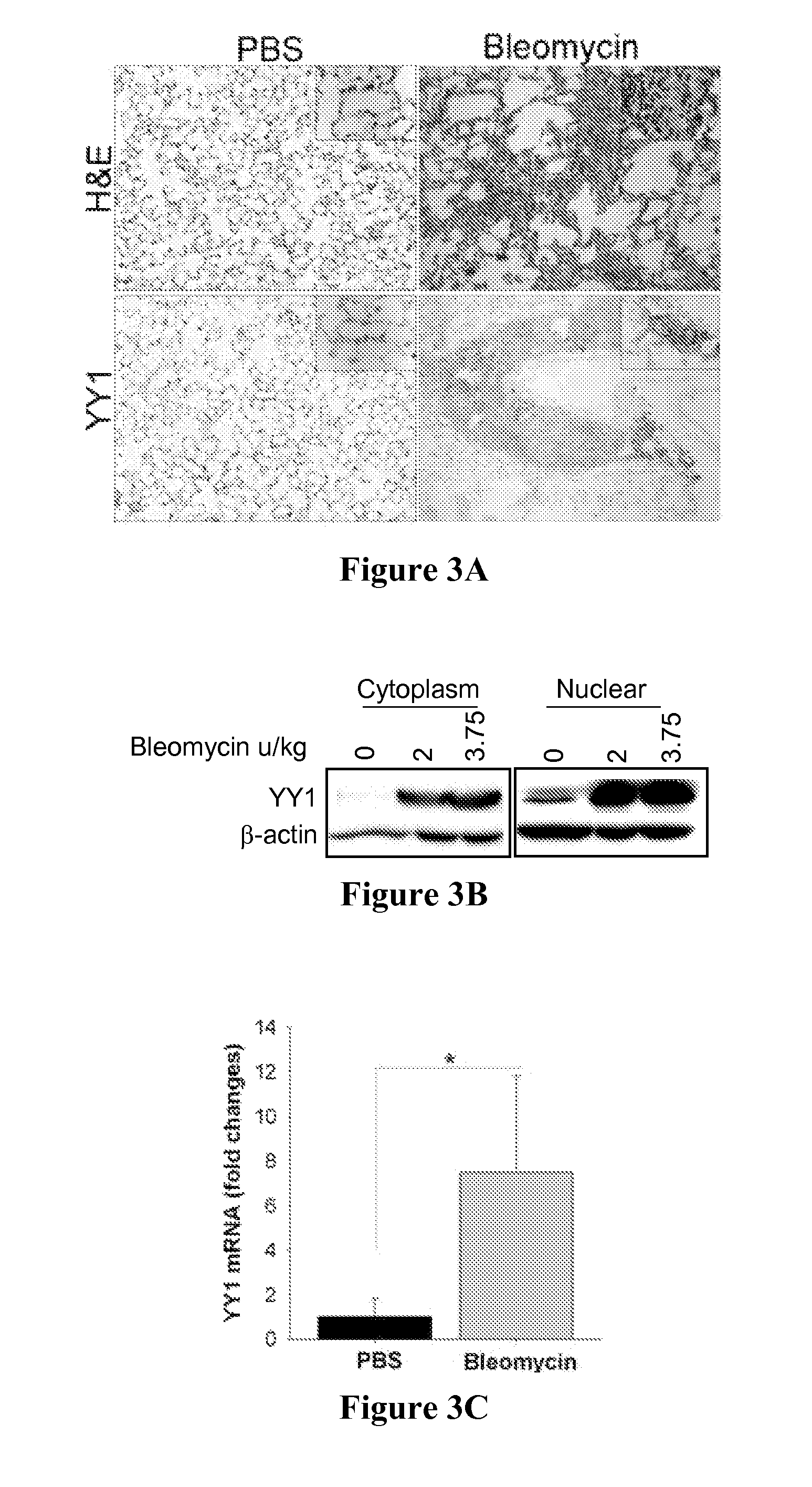 Methods of diagnosing and treating fibrosis