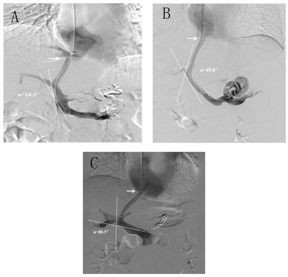 A kit for predicting stent restenosis after tips in patients with liver cirrhosis