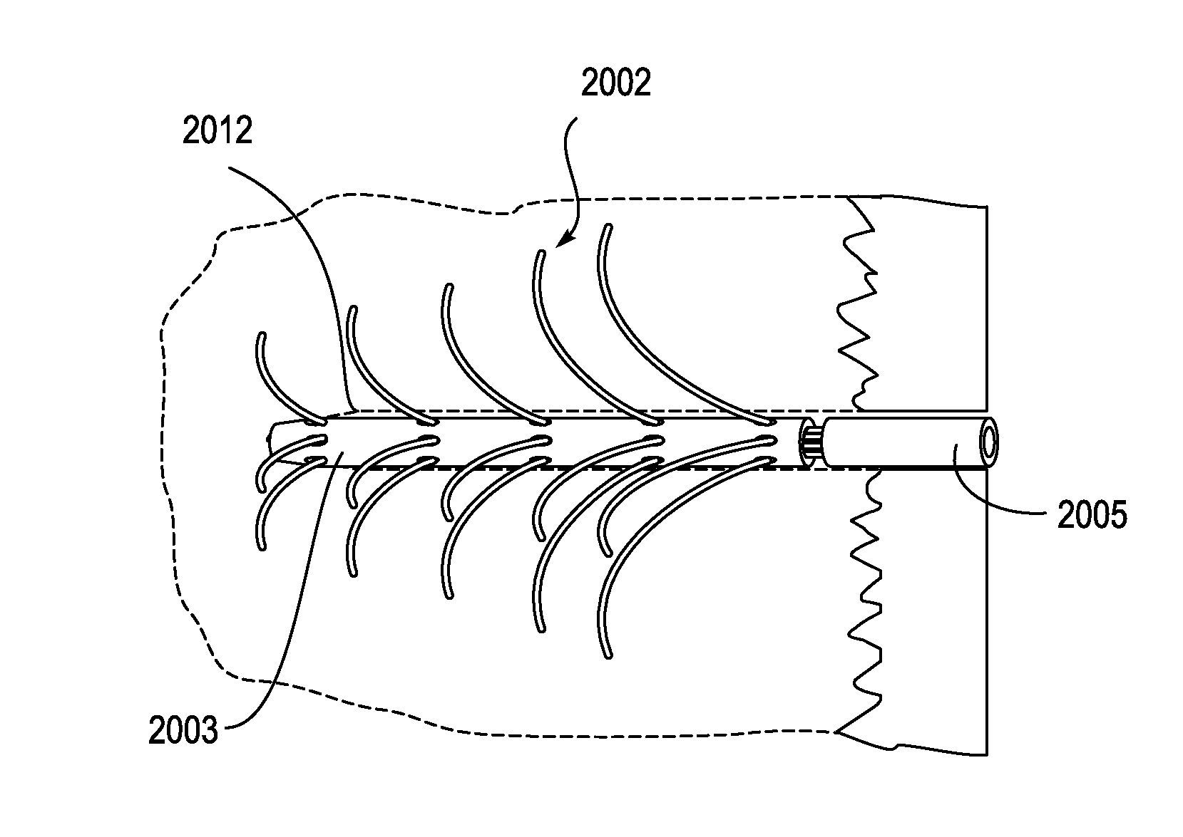 Bone implants for the treatment of infection