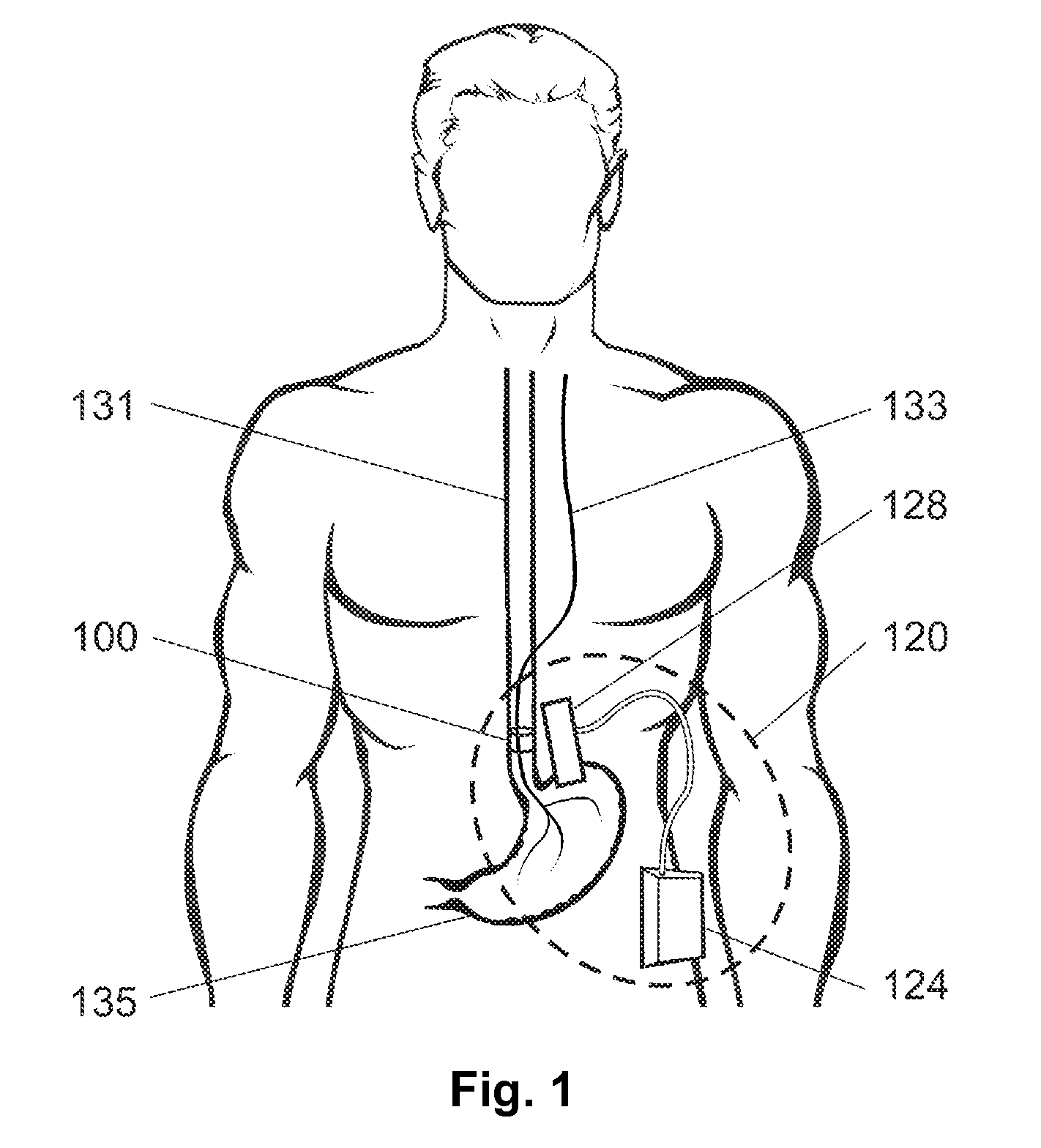 Non-surgical device and methods for trans-esophageal vagus nerve stimulation