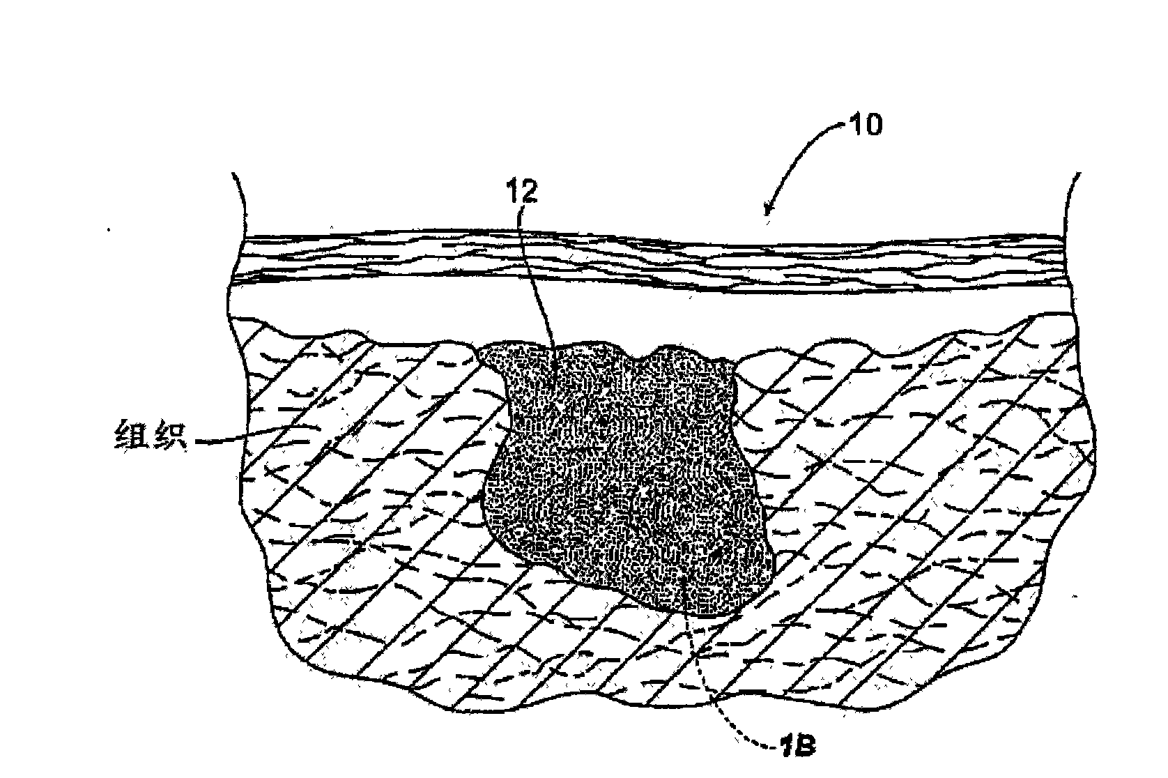 Hemostatic compositions, assemblies, systems, and methods employing particulate hemostatic agents formed from hydrophilic polymer foam such as chitosan