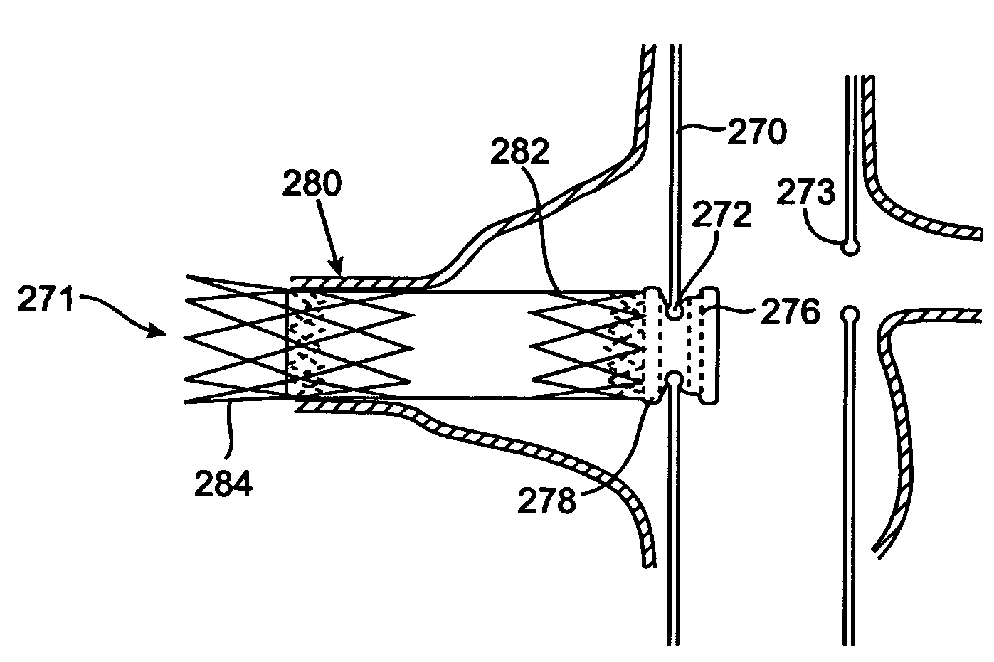 Branch vessel graft design and deployment method