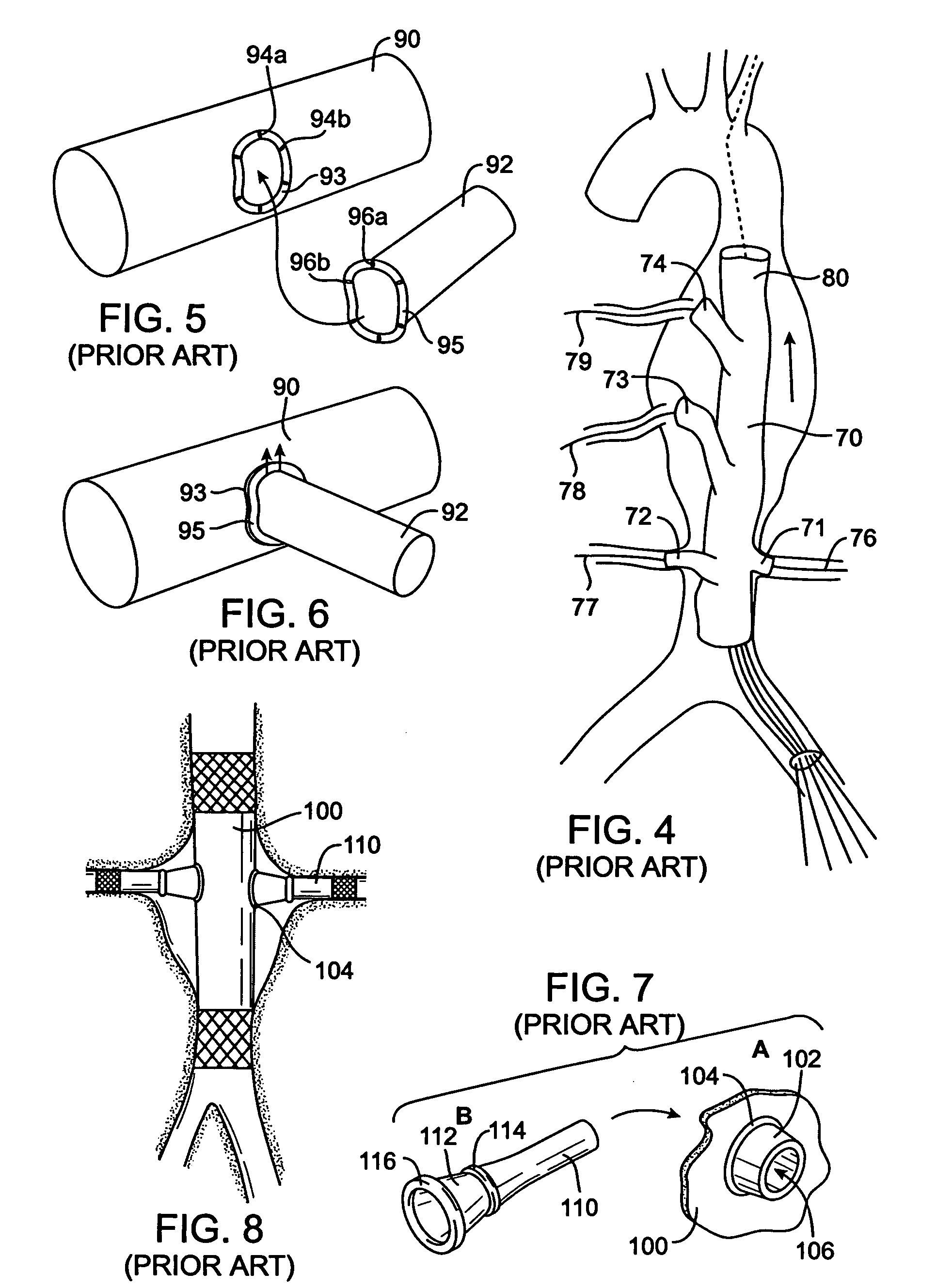 Branch vessel graft design and deployment method