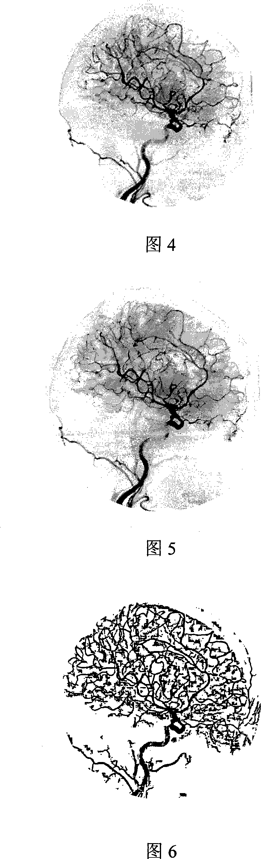 Method for segmenting blood vessel data using serial DSA image