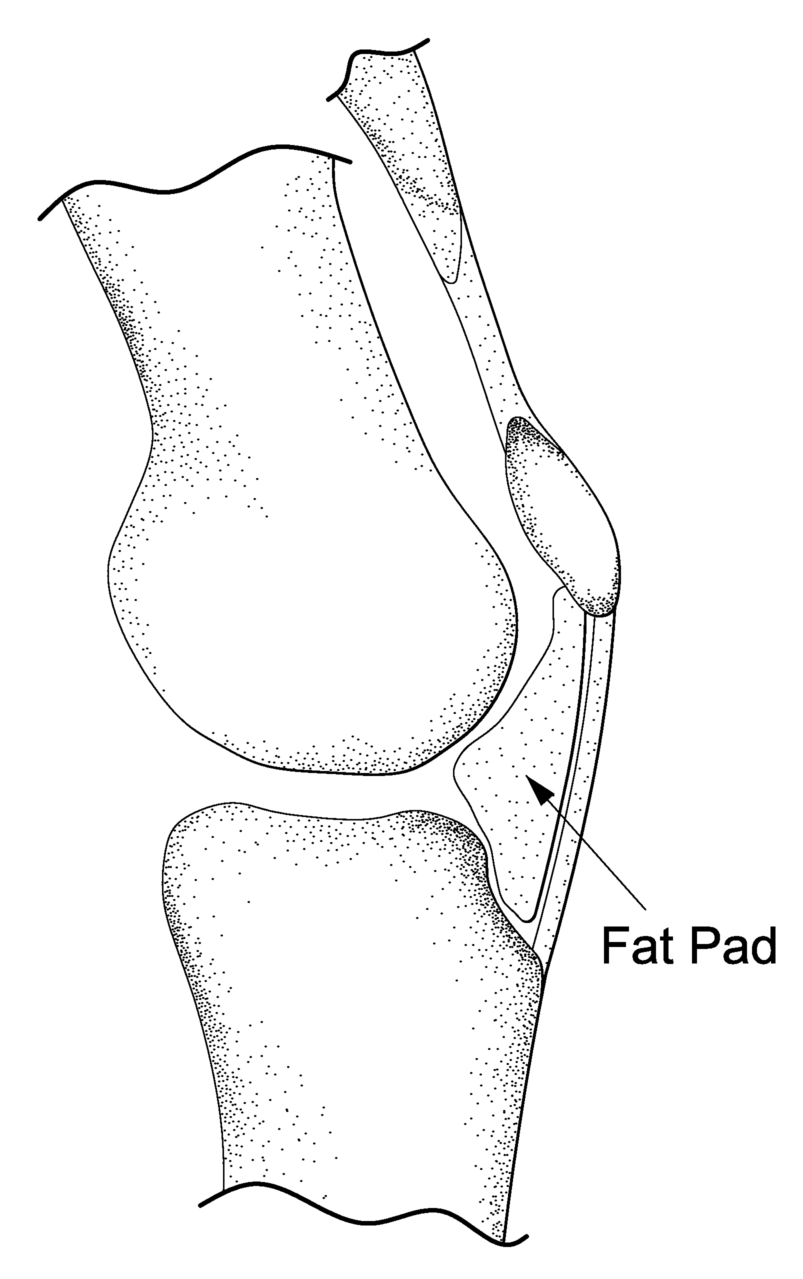 Method for improving cartilage repair and/or preventing cartilage degeneration in a joint