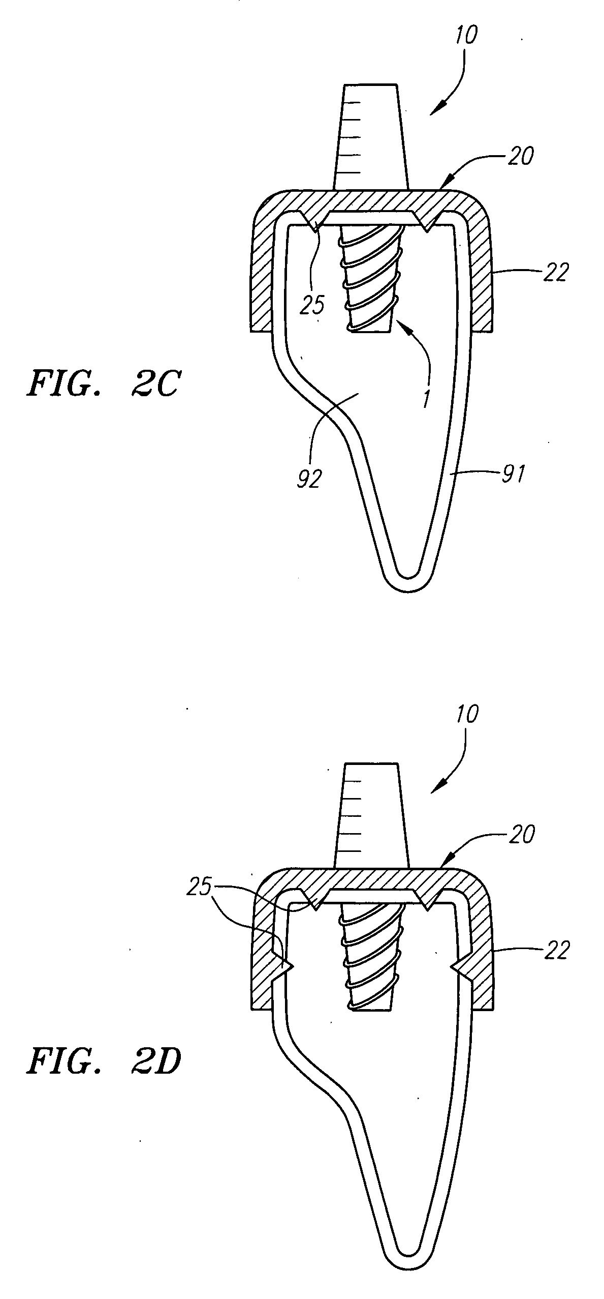 Dental implants with improved loading properties