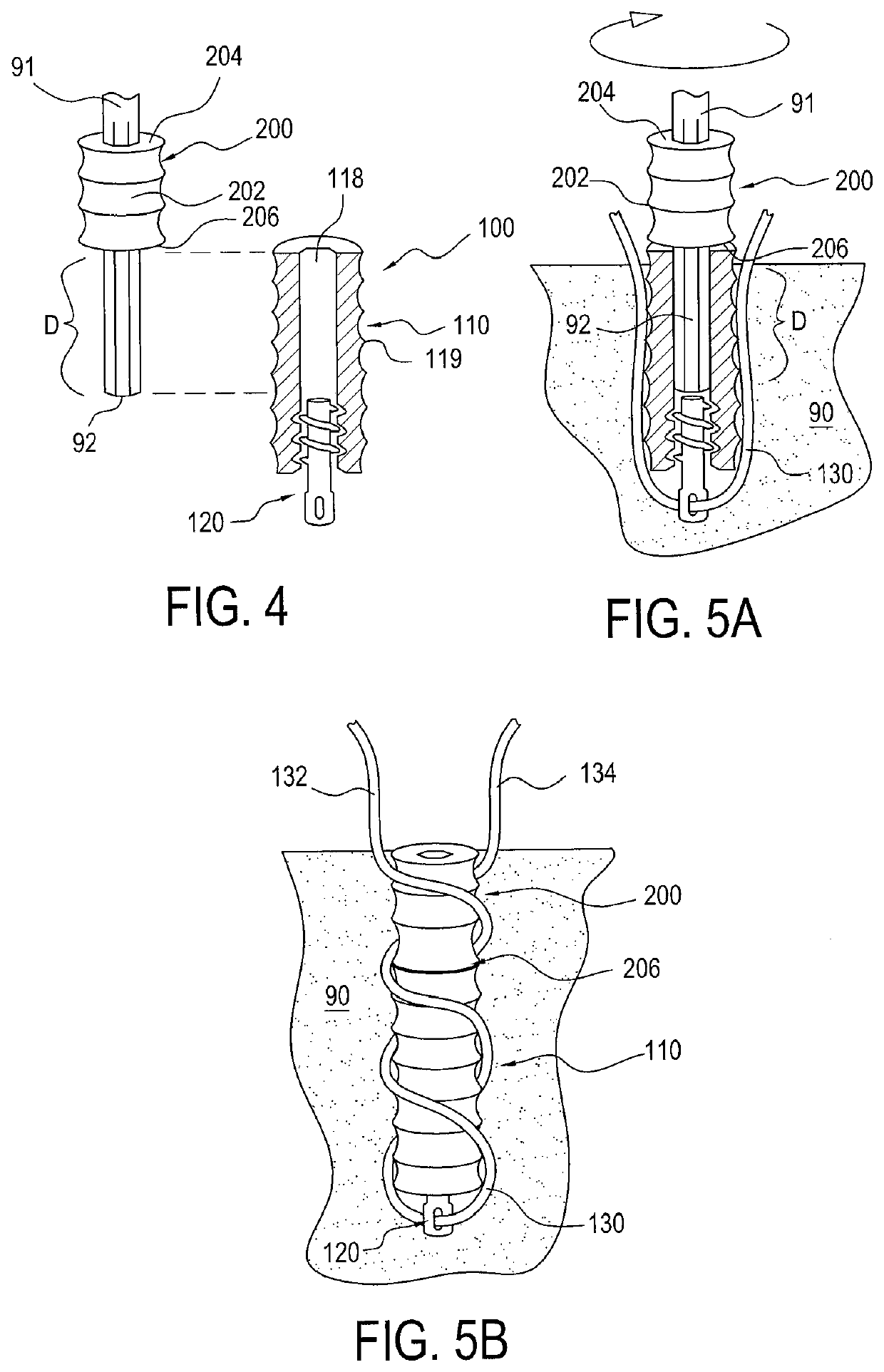 Slack reducing suture anchor assembly and method of tissue repair