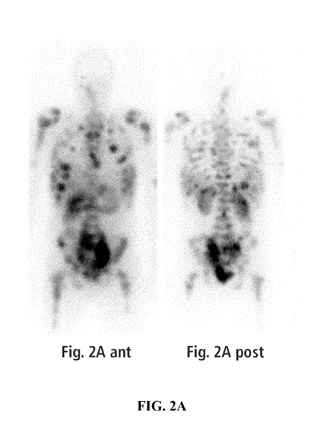 Methods of treating a neuroendocrine tumor