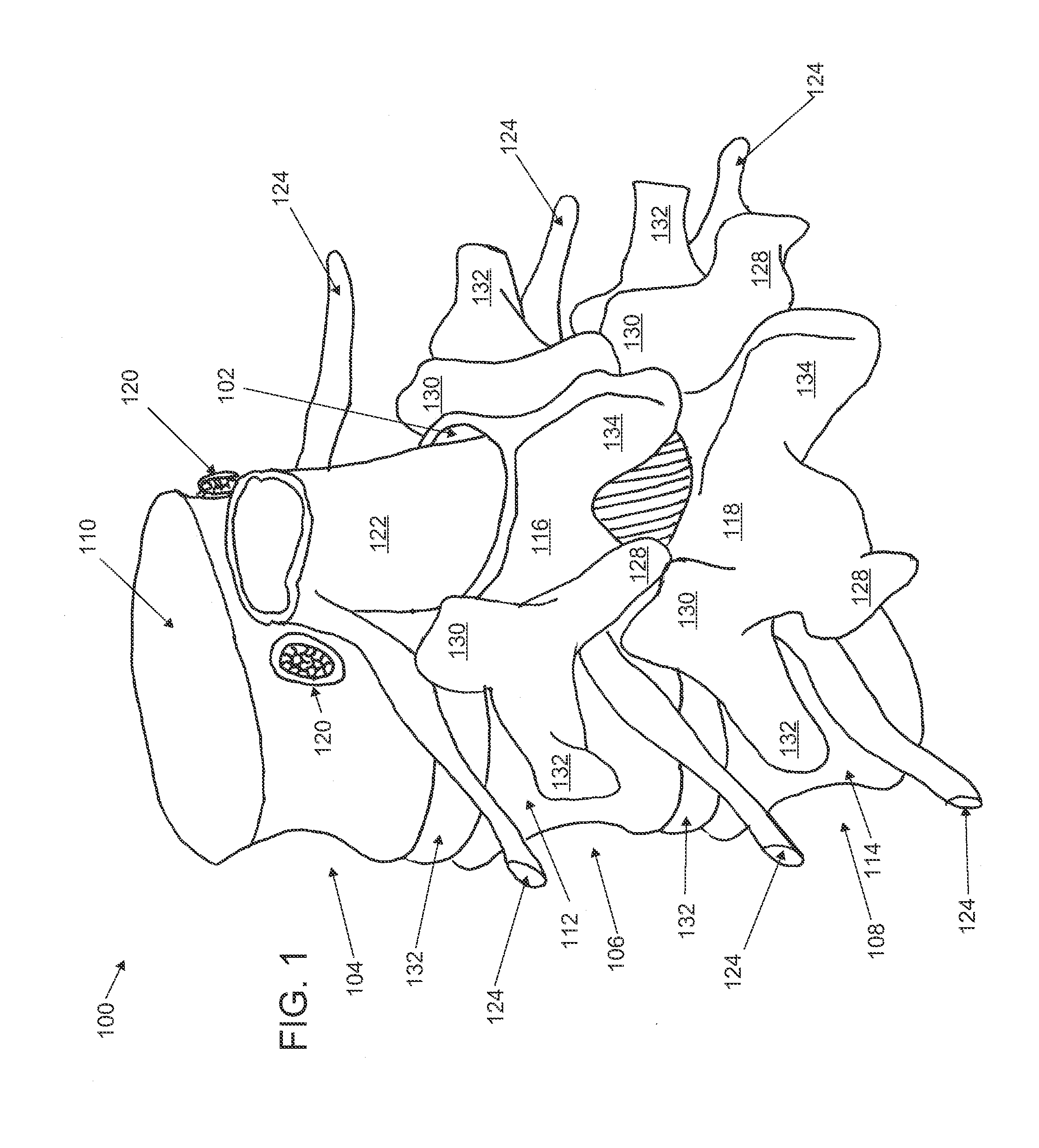 Method and devices for treating spinal stenosis