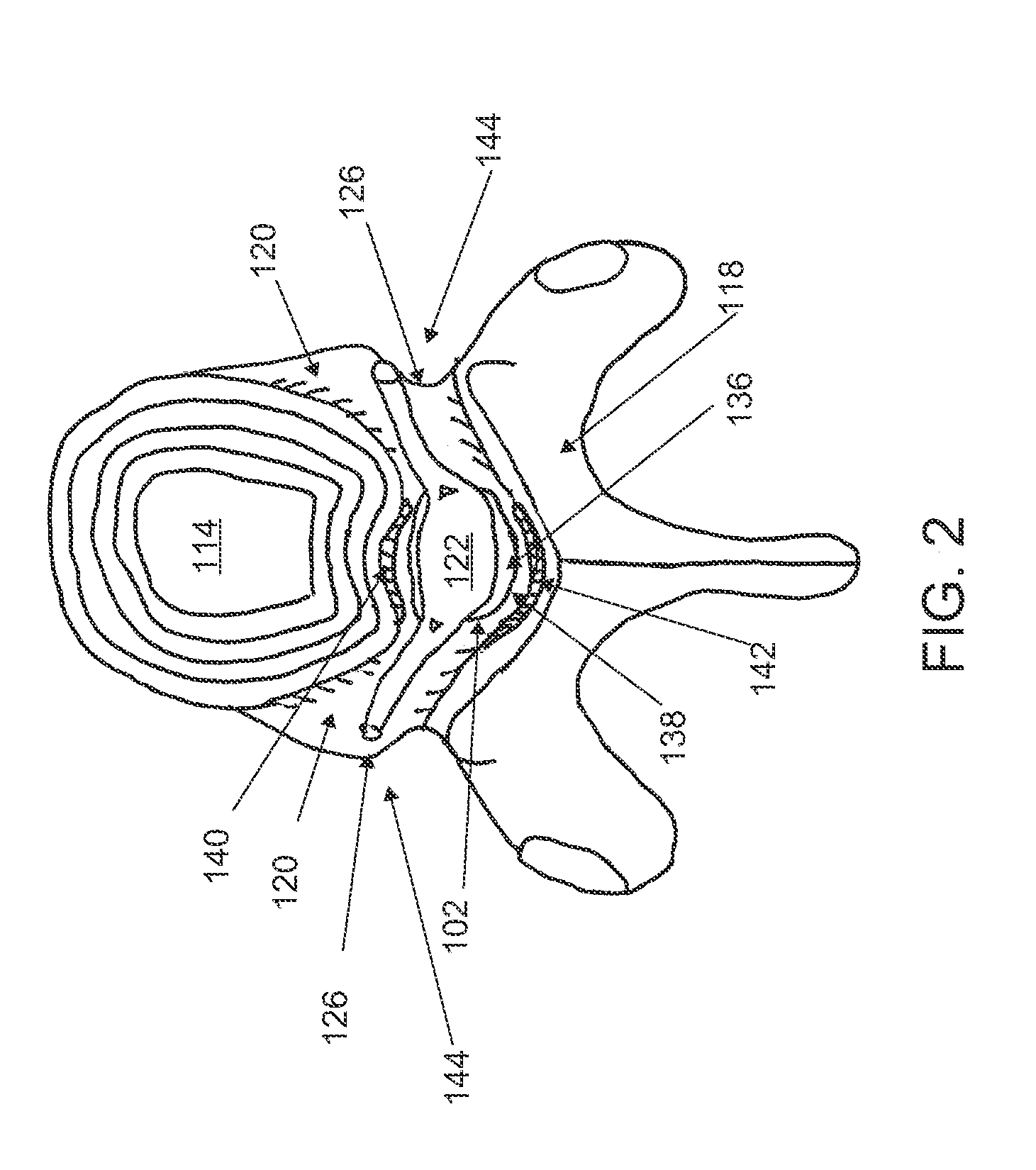 Method and devices for treating spinal stenosis