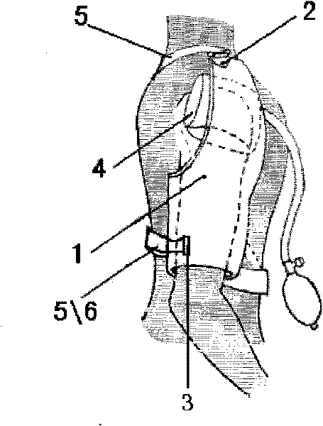 Single-shoulder adjustable clavicle fracture external fixator