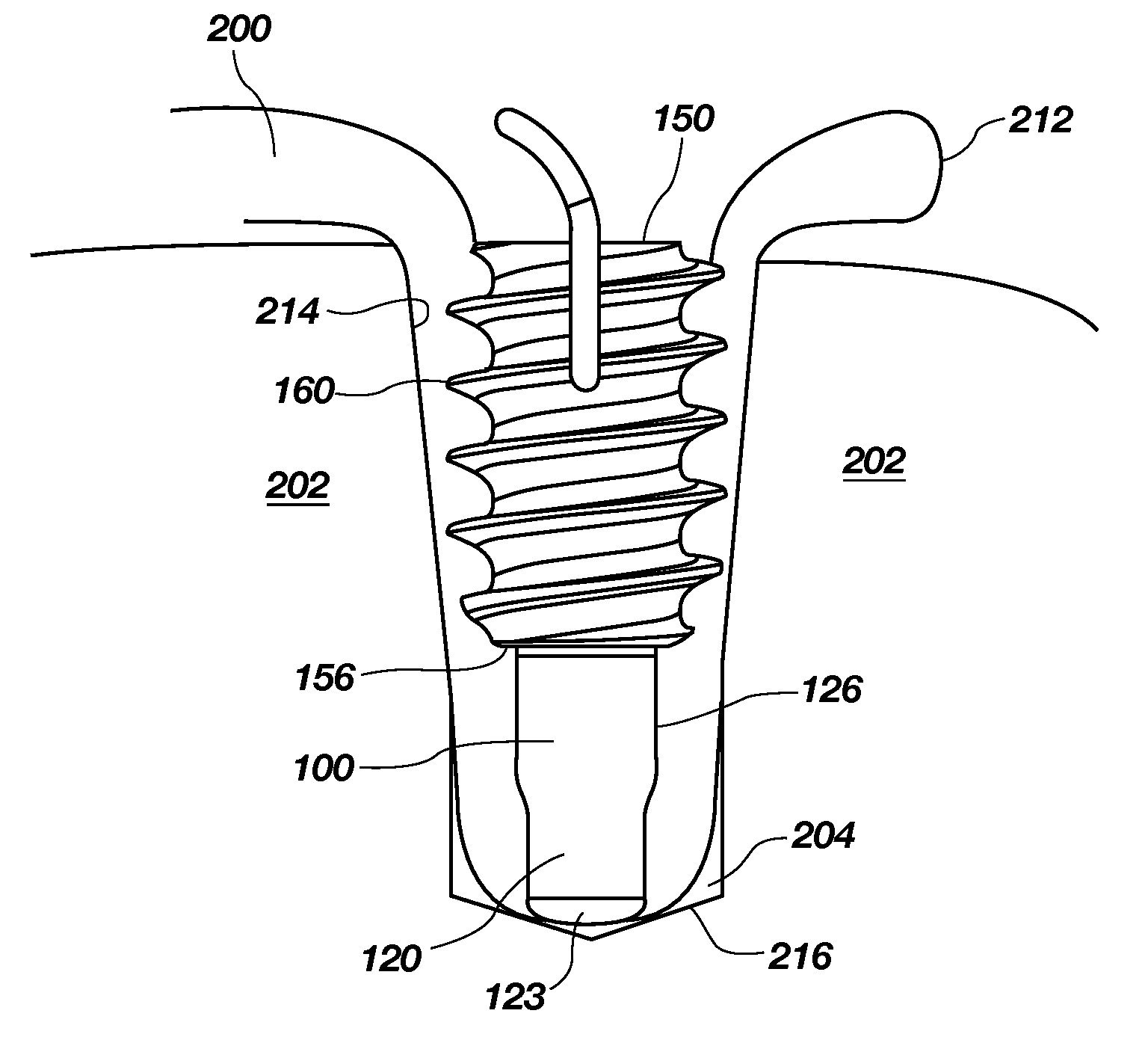 Tenodesis fixation method