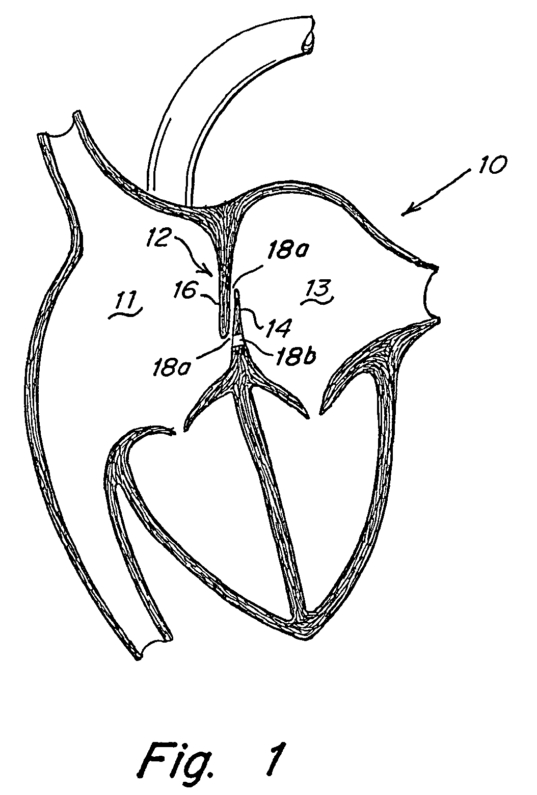 Occluder device double securement system for delivery/recovery of such occluder device