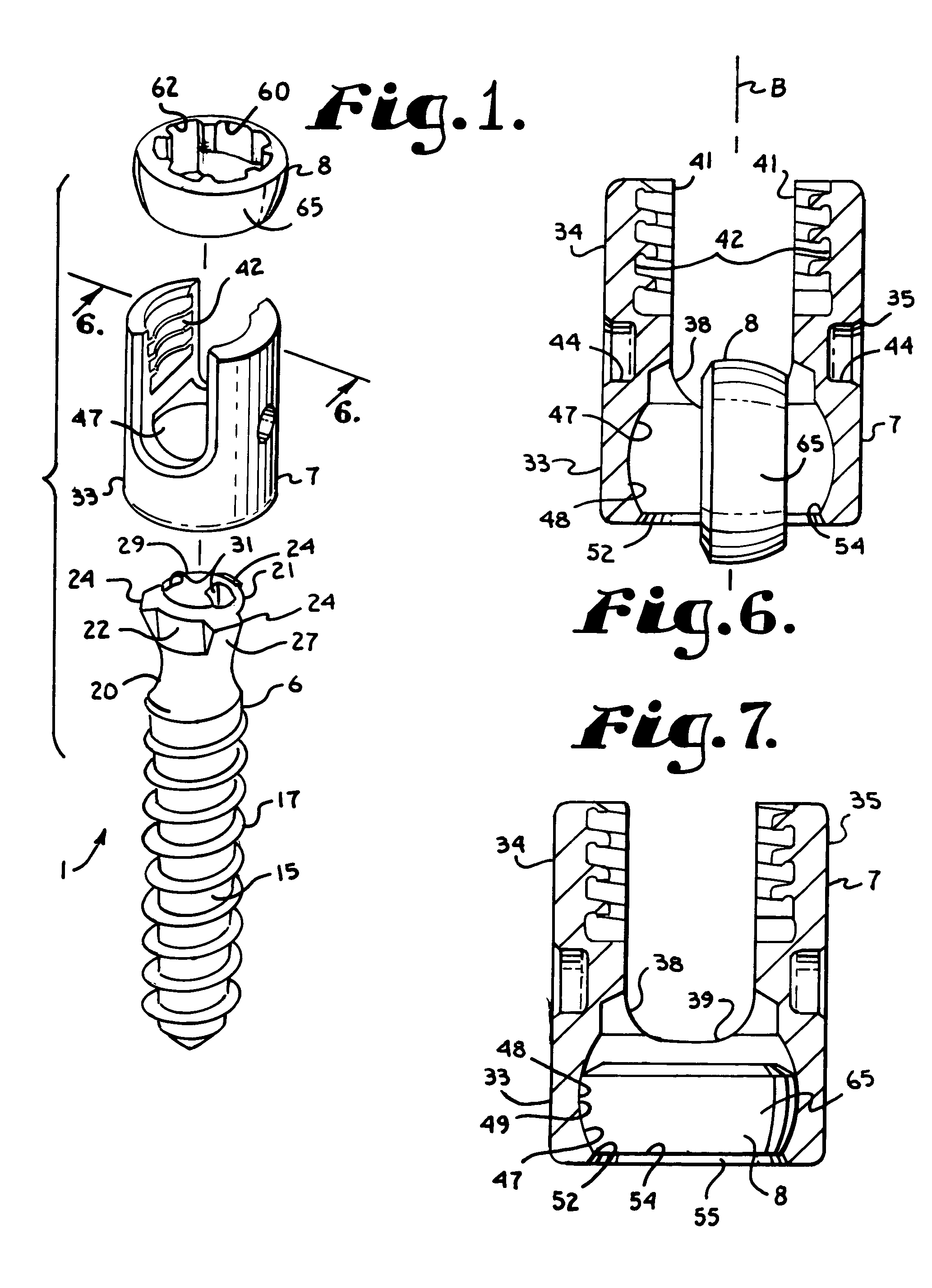 Upload shank swivel head bone screw spinal implant